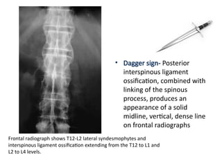Dagger Sign Radiograph IMAGING inflammatory joint disease in mRI,CT and USG.pptx