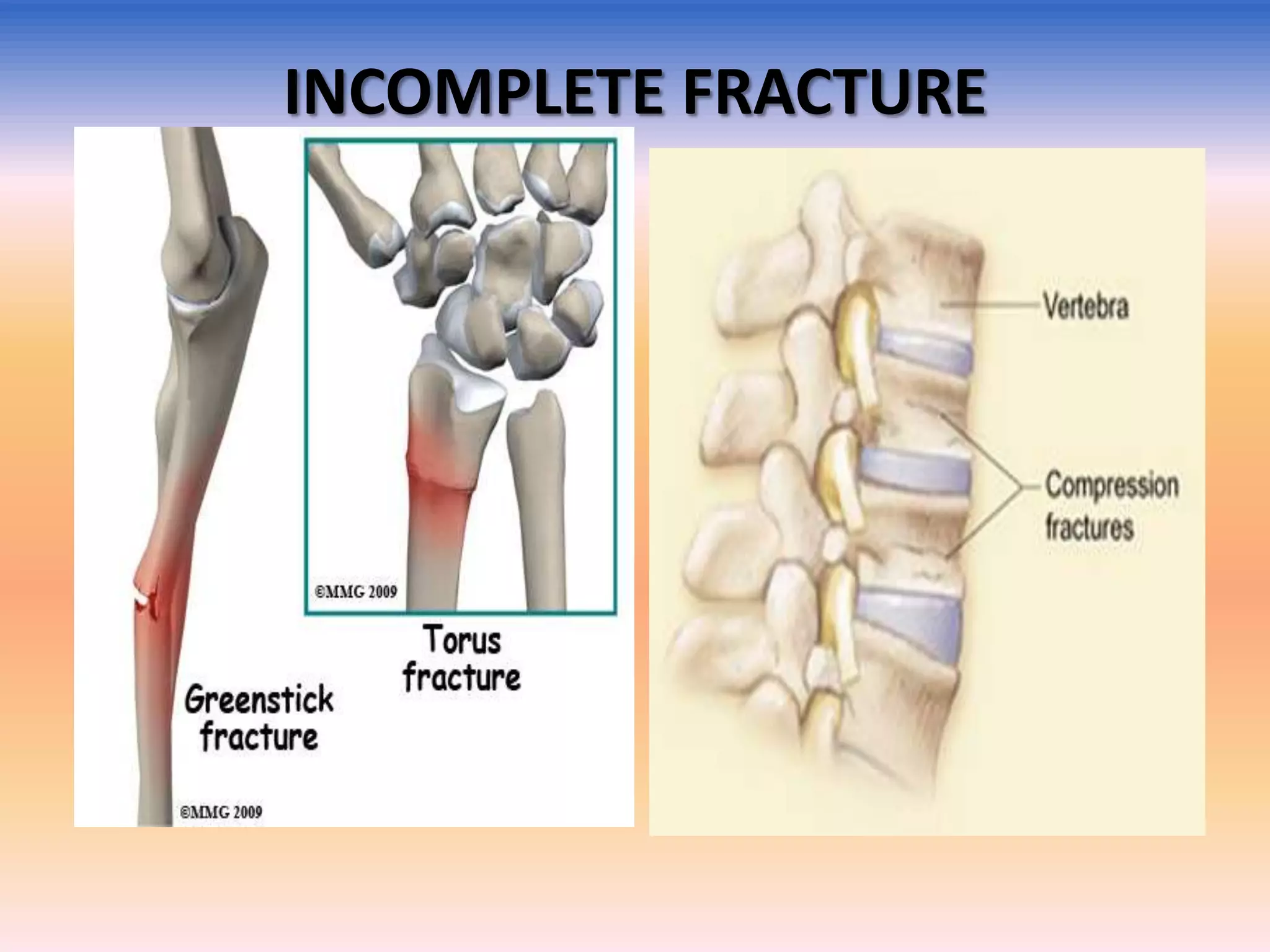 INCOMPLETE FRACTURE

 