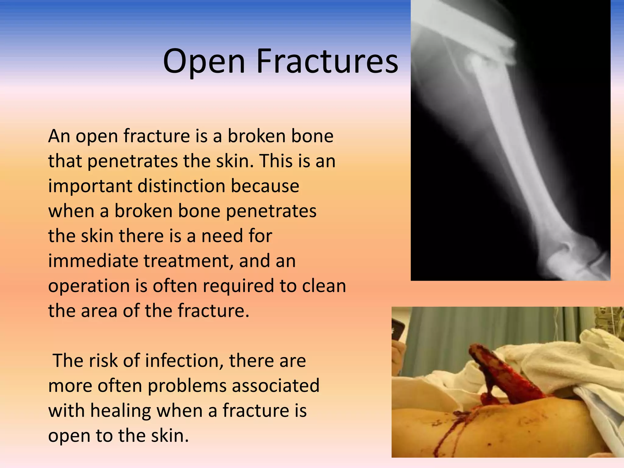 Open Fractures
An open fracture is a broken bone
that penetrates the skin. This is an
important distinction because
when a broken bone penetrates
the skin there is a need for
immediate treatment, and an
operation is often required to clean
the area of the fracture.
The risk of infection, there are
more often problems associated
with healing when a fracture is
open to the skin.

 