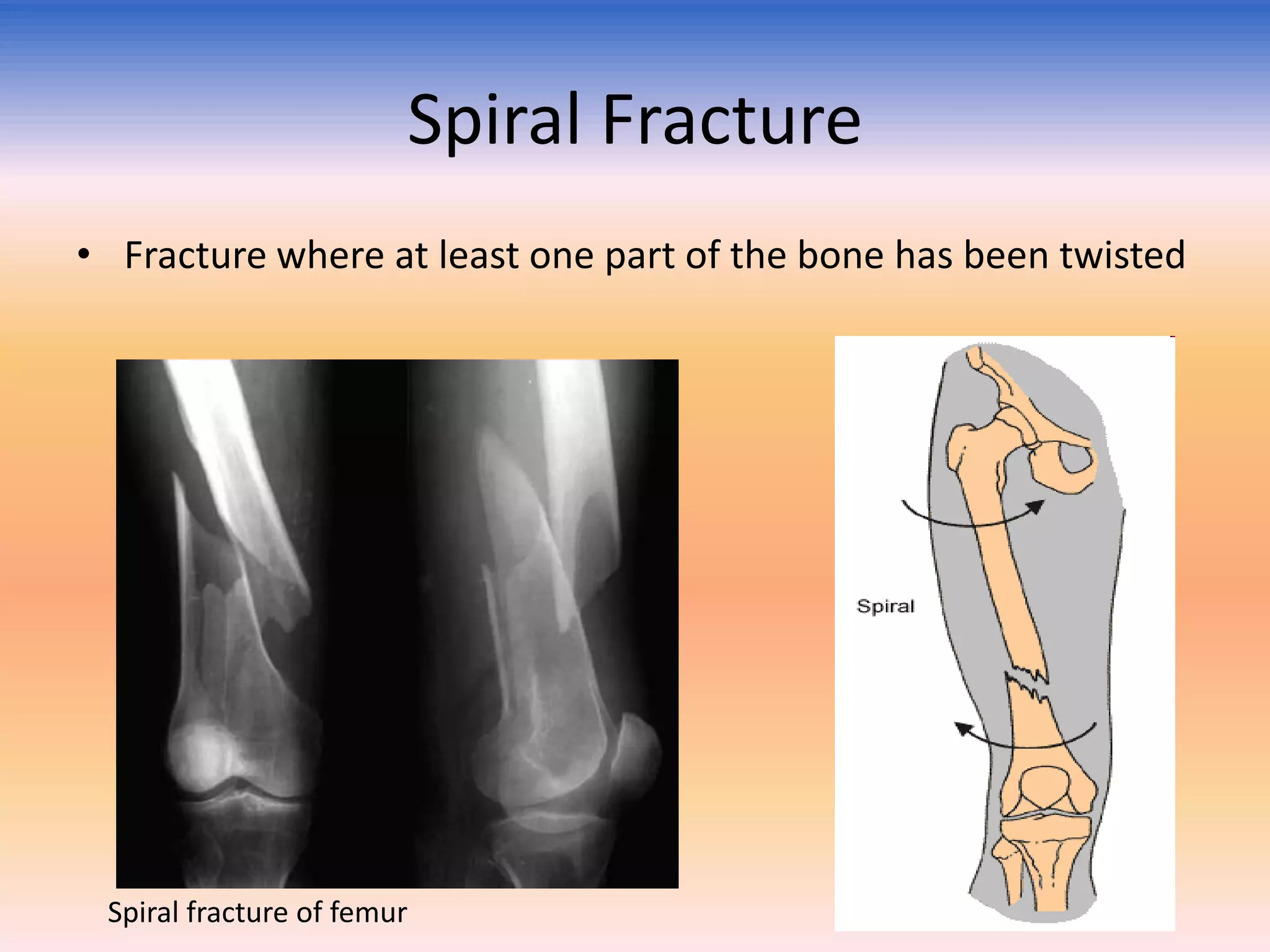Spiral Fracture
• Fracture where at least one part of the bone has been twisted

Spiral fracture of femur

 