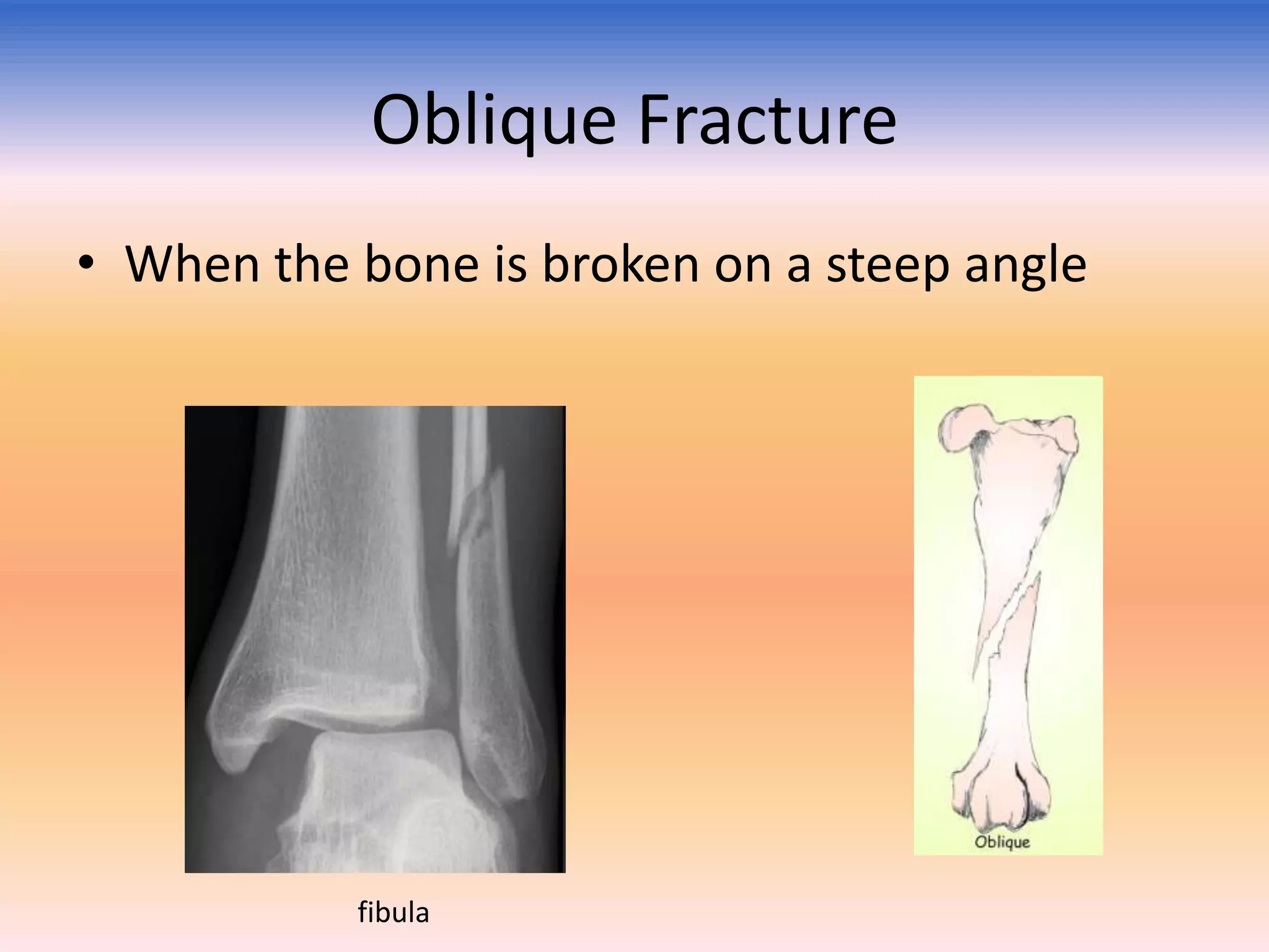 Oblique Fracture
• When the bone is broken on a steep angle

fibula

 