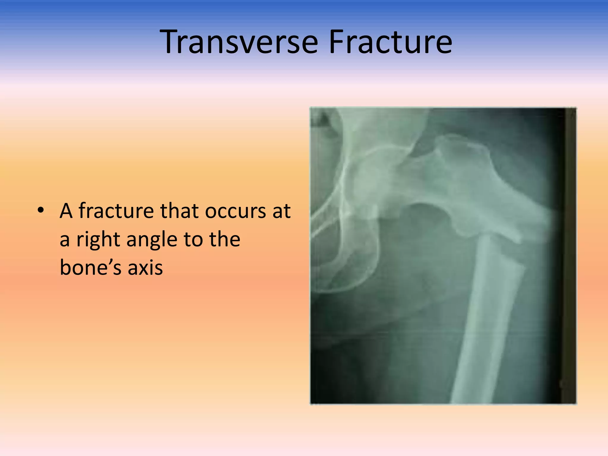 Transverse Fracture

• A fracture that occurs at
a right angle to the
bone’s axis

 