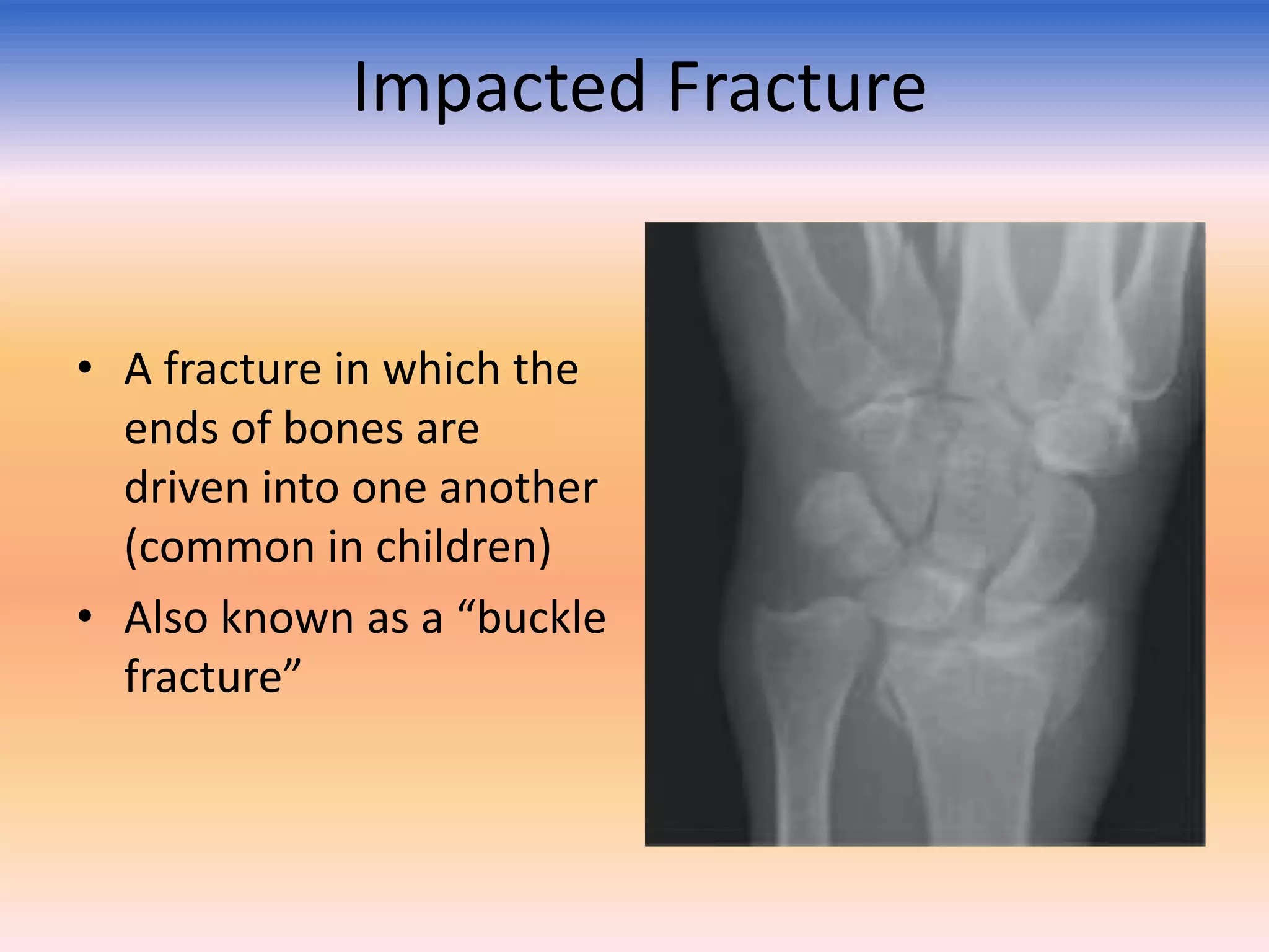 Impacted Fracture

• A fracture in which the
ends of bones are
driven into one another
(common in children)
• Also known as a “buckle
fracture”

 