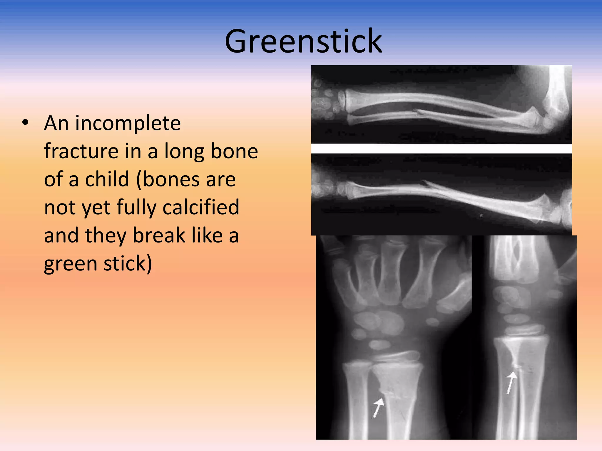 Greenstick
• An incomplete
fracture in a long bone
of a child (bones are
not yet fully calcified
and they break like a
green stick)

 