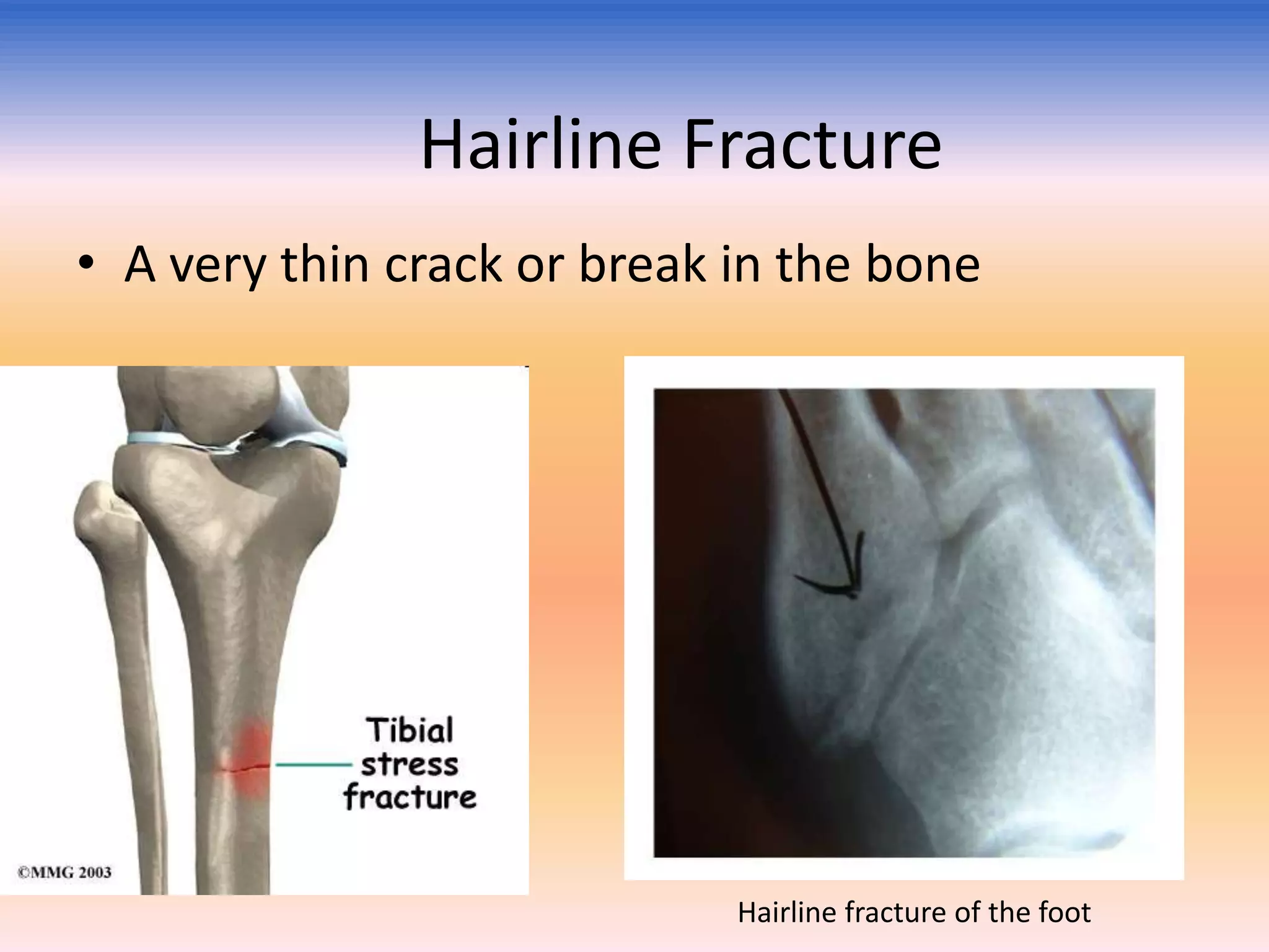 Hairline Fracture
• A very thin crack or break in the bone

Hairline fracture of the foot

 