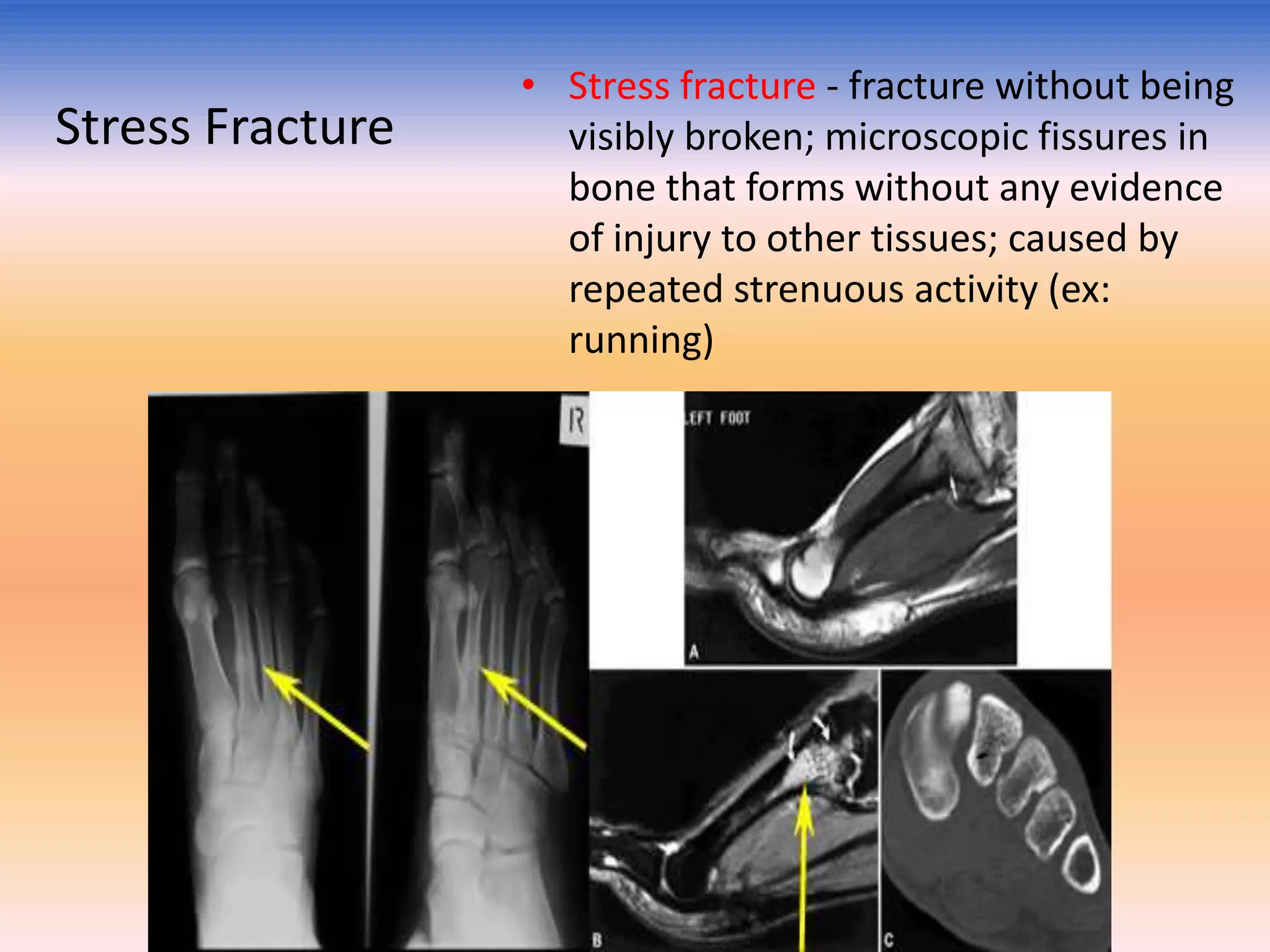 Stress Fracture

• Stress fracture - fracture without being
visibly broken; microscopic fissures in
bone that forms without any evidence
of injury to other tissues; caused by
repeated strenuous activity (ex:
running)

 