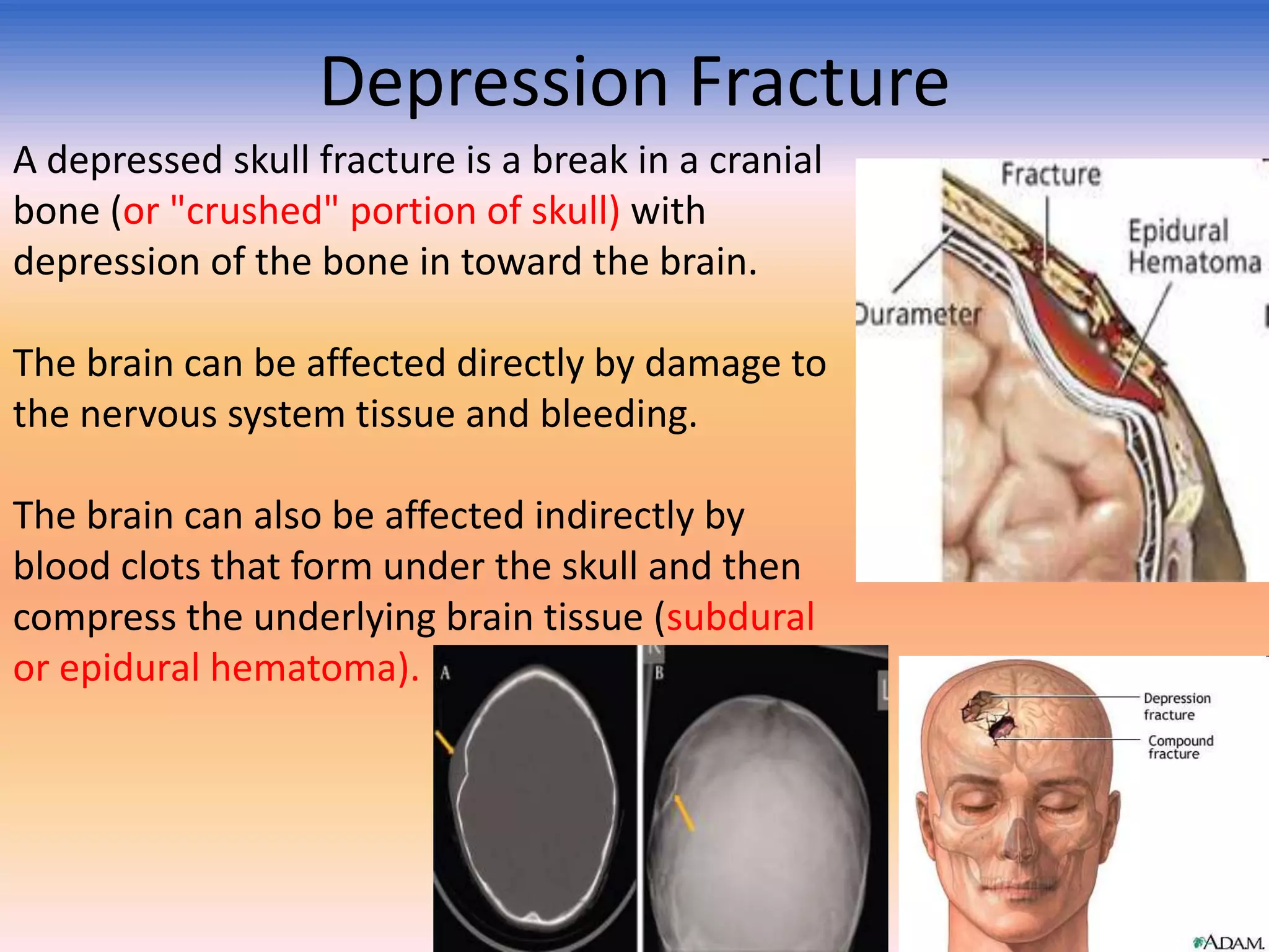 Depression Fracture
A depressed skull fracture is a break in a cranial
bone (or "crushed" portion of skull) with
depression of the bone in toward the brain.
The brain can be affected directly by damage to
the nervous system tissue and bleeding.
The brain can also be affected indirectly by
blood clots that form under the skull and then
compress the underlying brain tissue (subdural
or epidural hematoma).

 