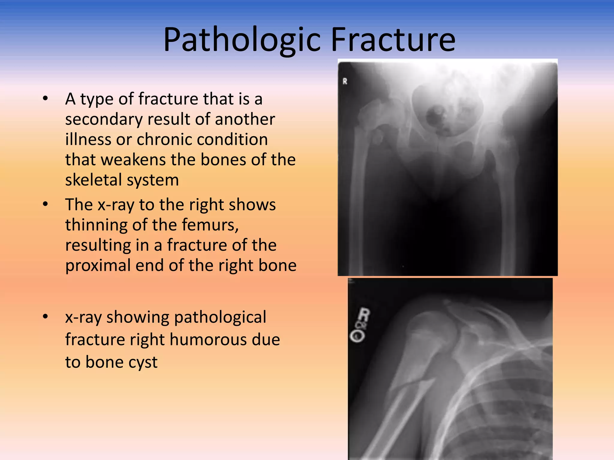 Pathologic Fracture
• A type of fracture that is a
secondary result of another
illness or chronic condition
that weakens the bones of the
skeletal system
• The x-ray to the right shows
thinning of the femurs,
resulting in a fracture of the
proximal end of the right bone
• x-ray showing pathological
fracture right humorous due
to bone cyst

 