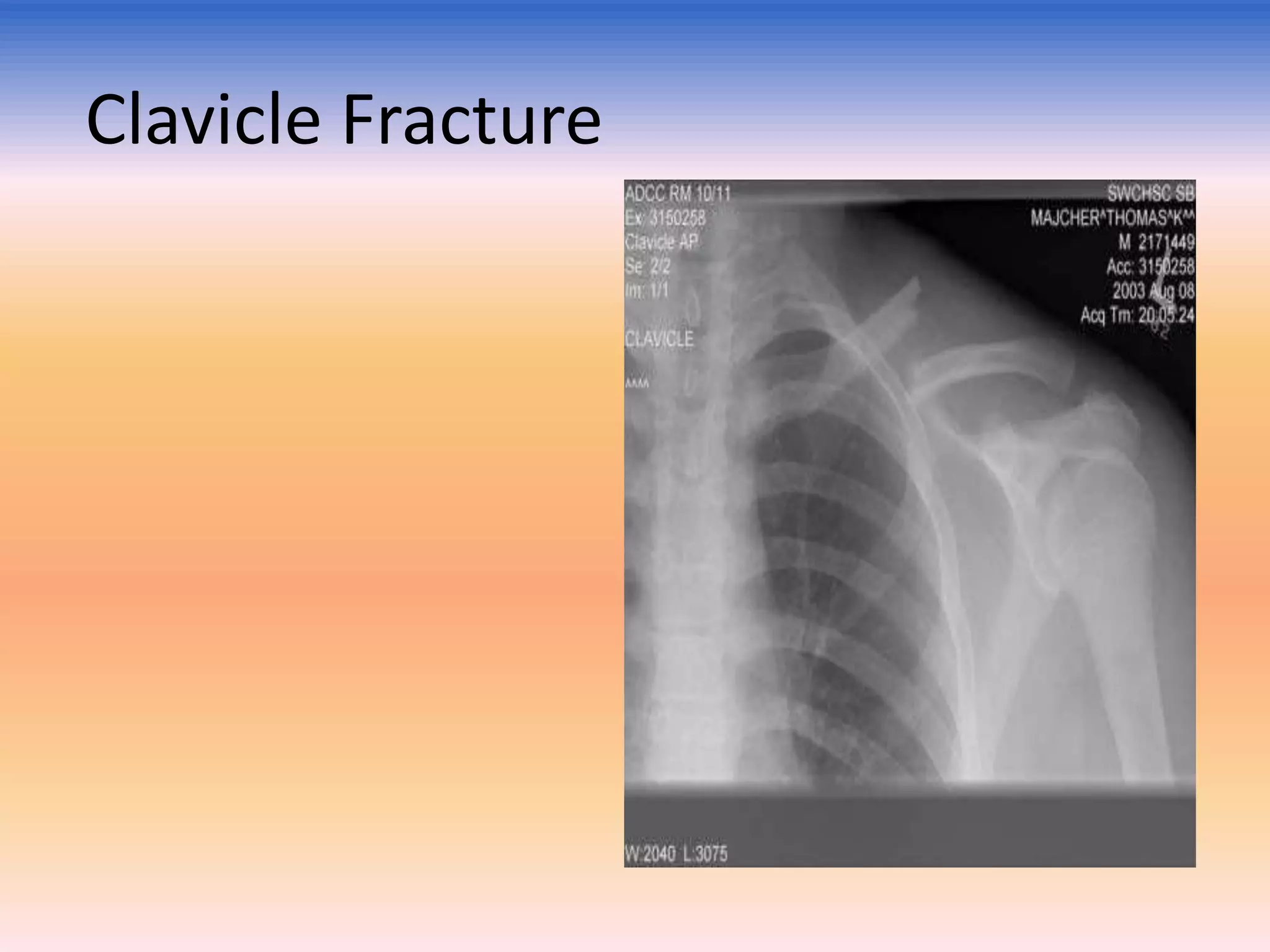 Clavicle Fracture

 