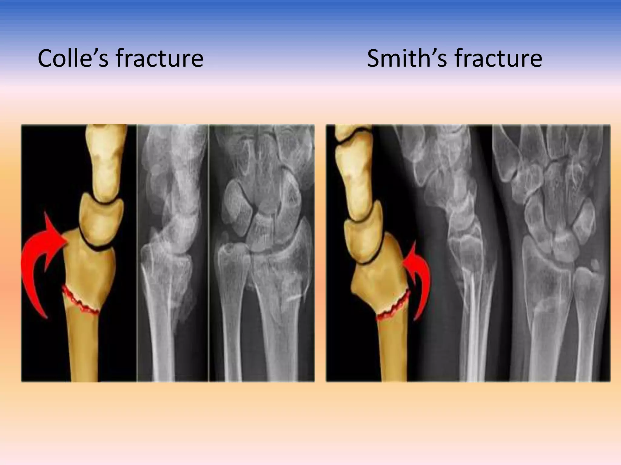 Colle’s fracture

Smith’s fracture

 