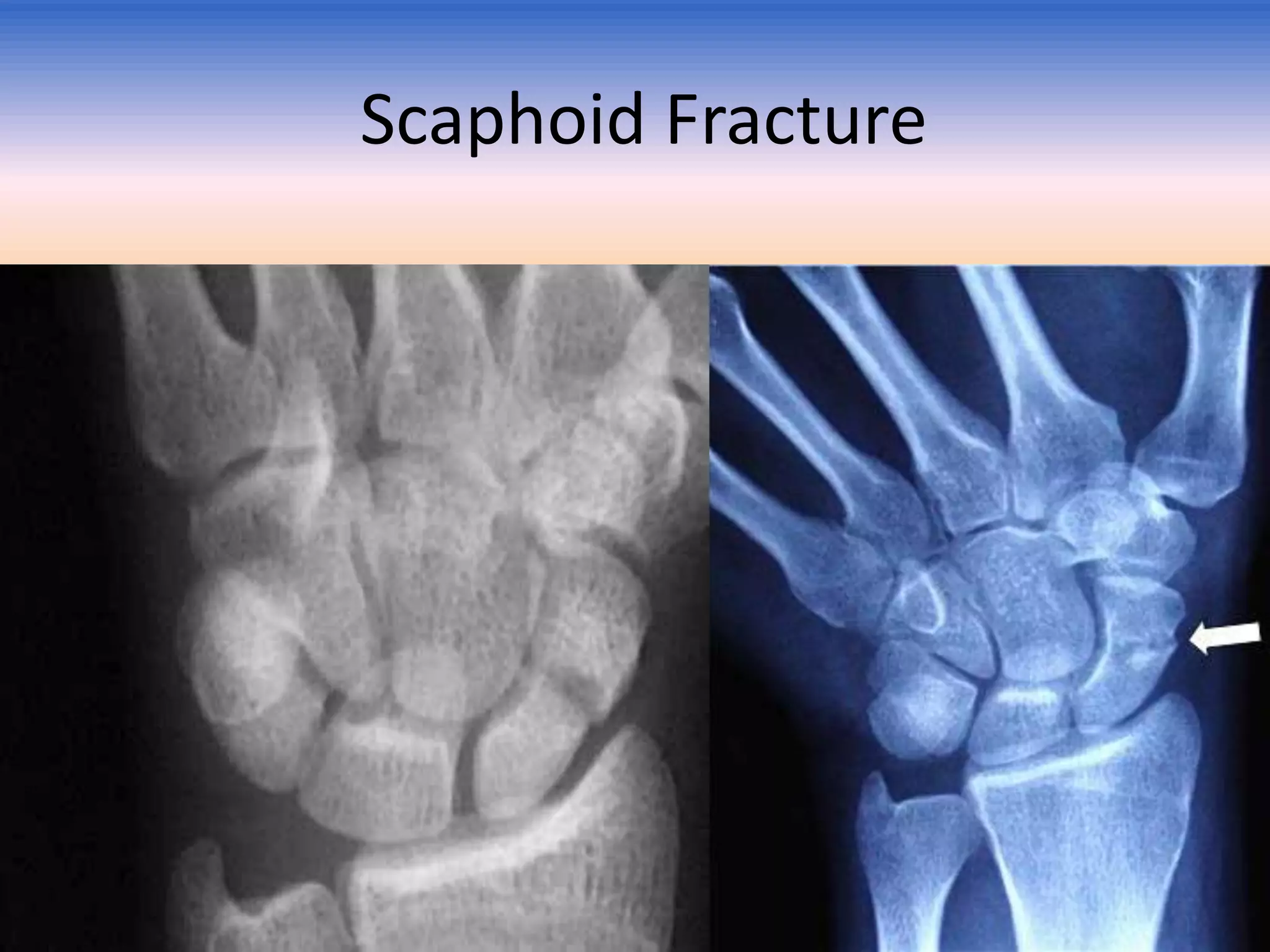Scaphoid Fracture

 