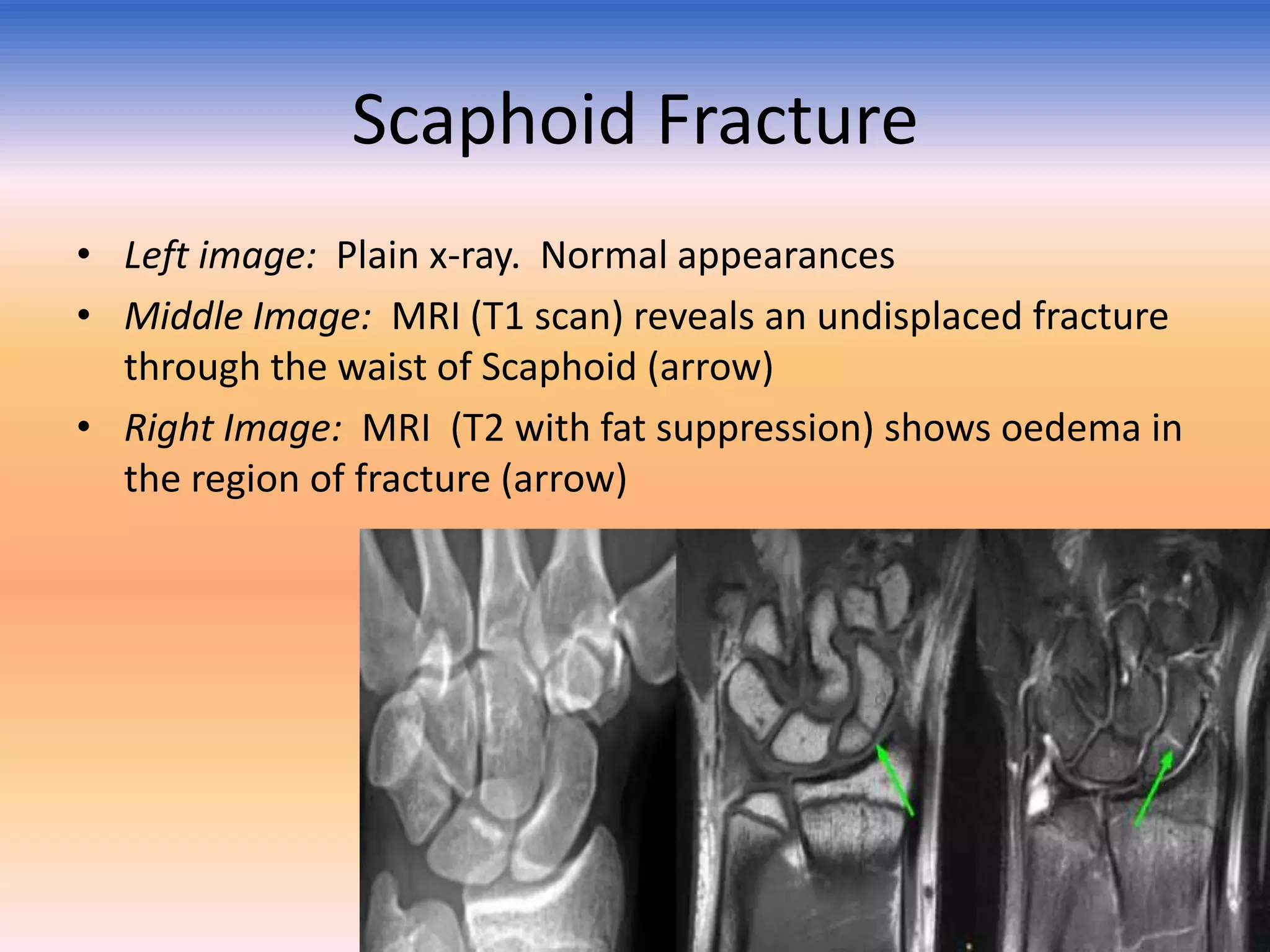 Scaphoid Fracture
• Left image: Plain x-ray. Normal appearances
• Middle Image: MRI (T1 scan) reveals an undisplaced fracture
through the waist of Scaphoid (arrow)
• Right Image: MRI (T2 with fat suppression) shows oedema in
the region of fracture (arrow)

 