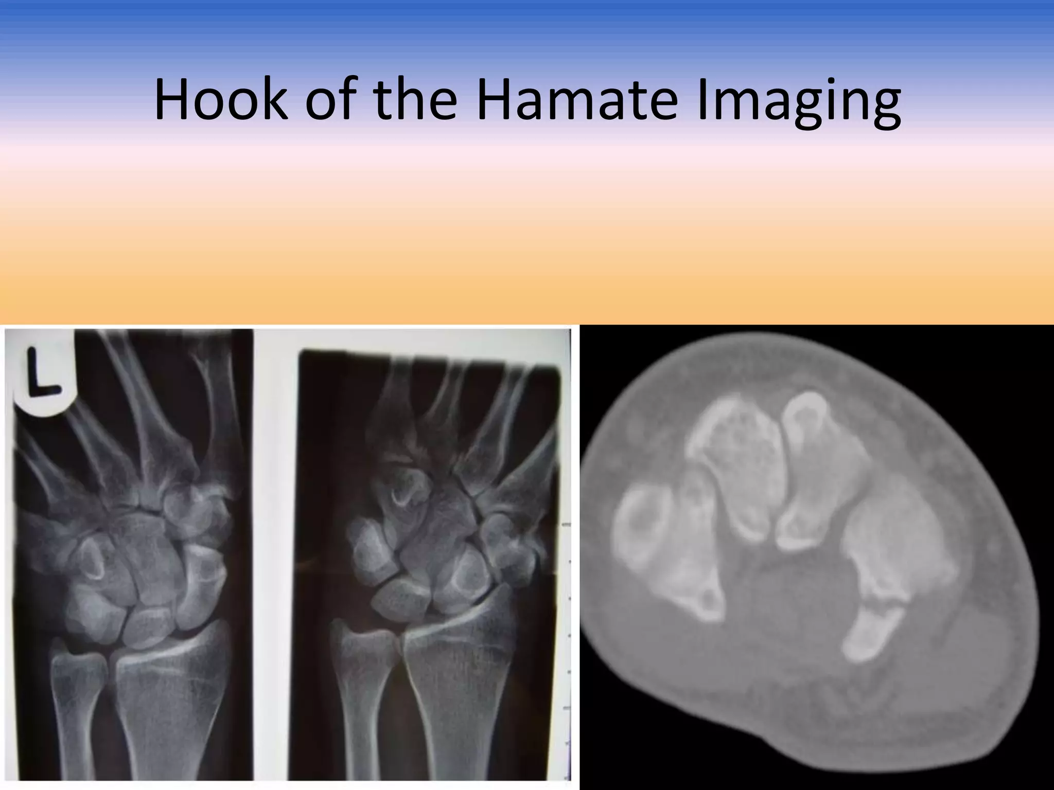 Hook of the Hamate Imaging

 