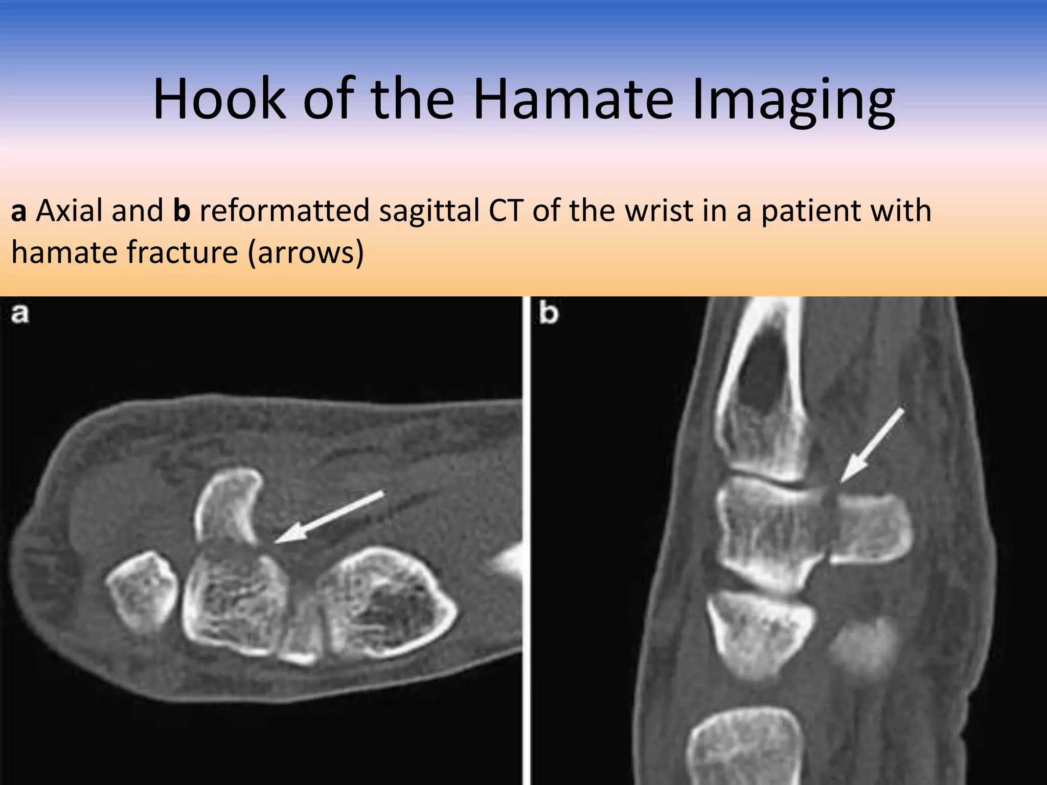 Hook of the Hamate Imaging
a Axial and b reformatted sagittal CT of the wrist in a patient with
hamate fracture (arrows)

 