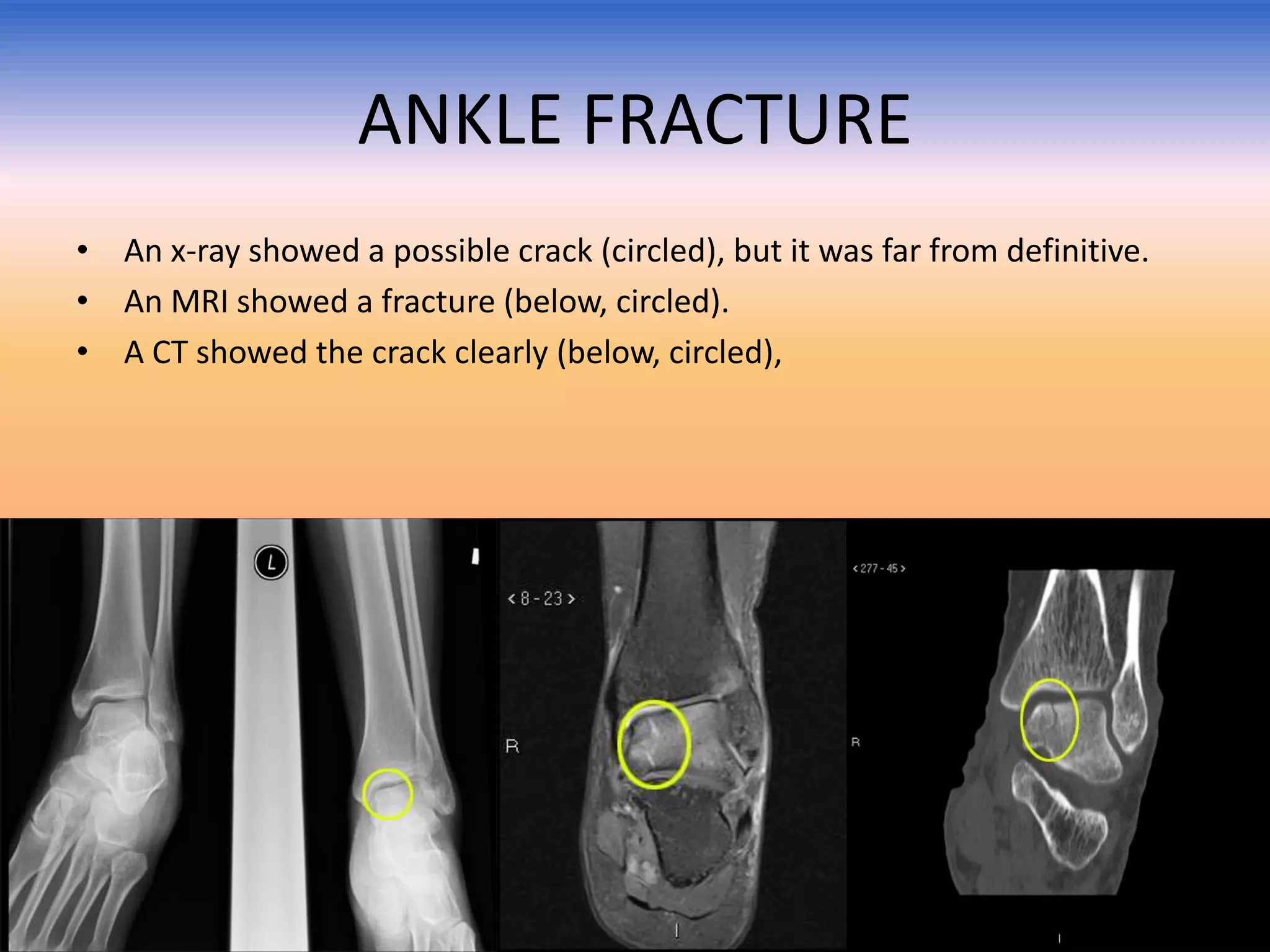 ANKLE FRACTURE
• An x-ray showed a possible crack (circled), but it was far from definitive.
• An MRI showed a fracture (below, circled).
• A CT showed the crack clearly (below, circled),

 