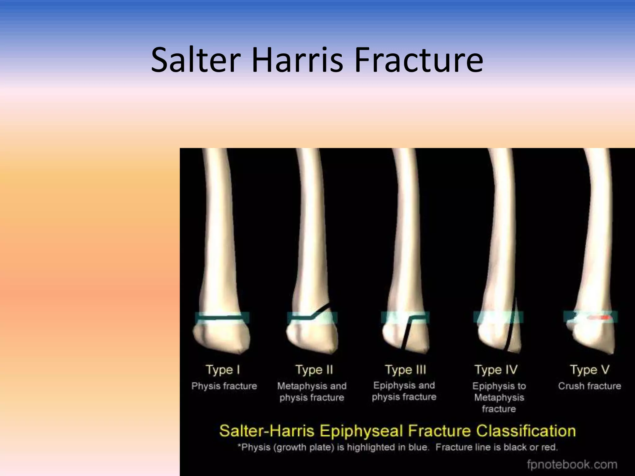 Salter Harris Fracture

 