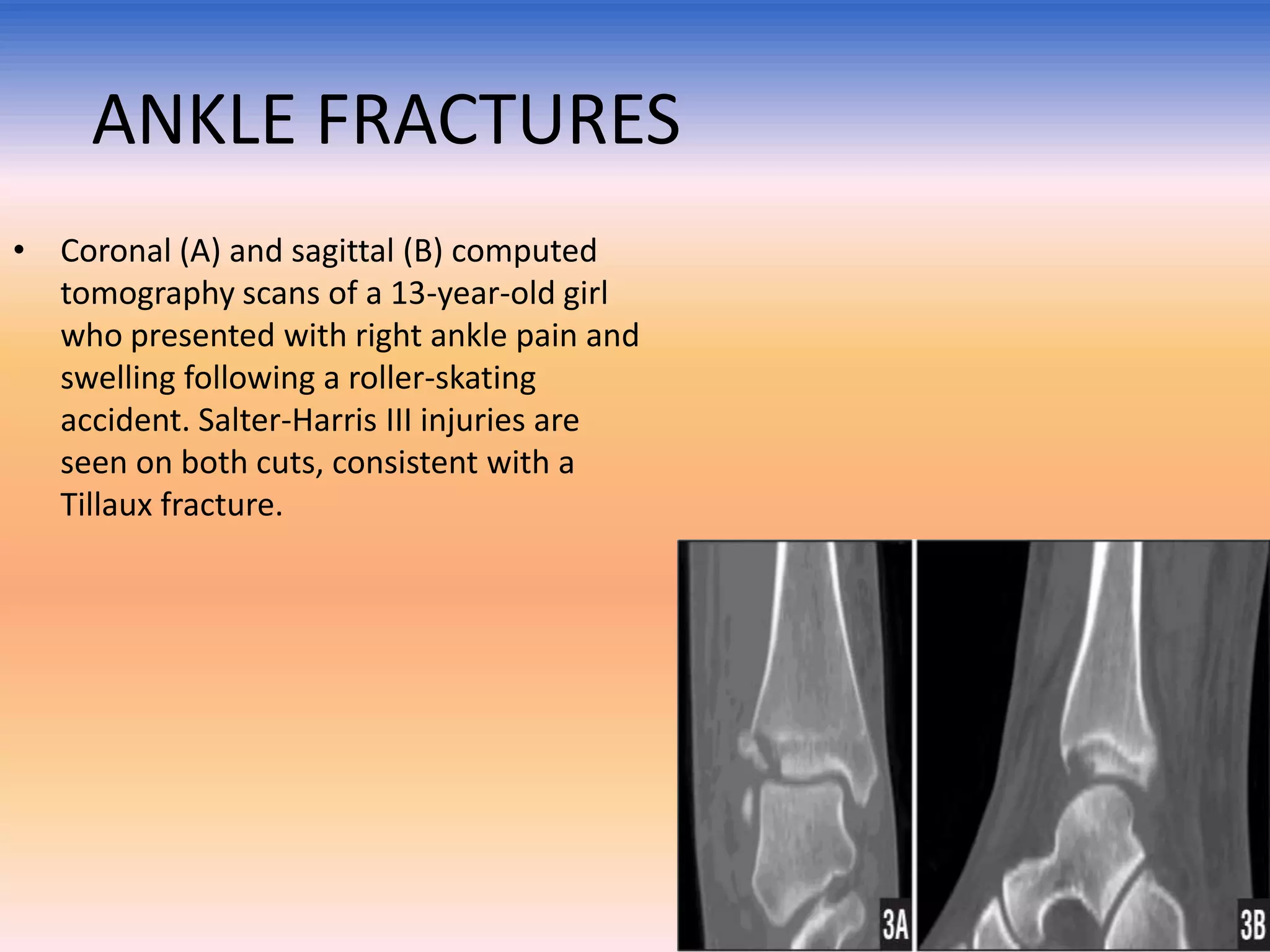ANKLE FRACTURES
• Coronal (A) and sagittal (B) computed
tomography scans of a 13-year-old girl
who presented with right ankle pain and
swelling following a roller-skating
accident. Salter-Harris III injuries are
seen on both cuts, consistent with a
Tillaux fracture.

 