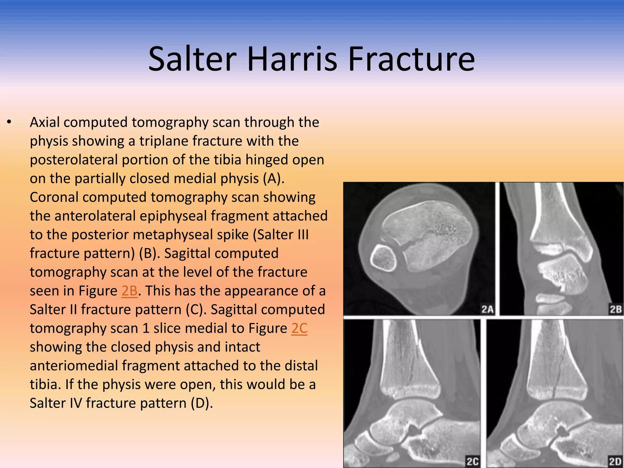 Salter Harris Fracture
•

Axial computed tomography scan through the
physis showing a triplane fracture with the
posterolateral portion of the tibia hinged open
on the partially closed medial physis (A).
Coronal computed tomography scan showing
the anterolateral epiphyseal fragment attached
to the posterior metaphyseal spike (Salter III
fracture pattern) (B). Sagittal computed
tomography scan at the level of the fracture
seen in Figure 2B. This has the appearance of a
Salter II fracture pattern (C). Sagittal computed
tomography scan 1 slice medial to Figure 2C
showing the closed physis and intact
anteriomedial fragment attached to the distal
tibia. If the physis were open, this would be a
Salter IV fracture pattern (D).

 