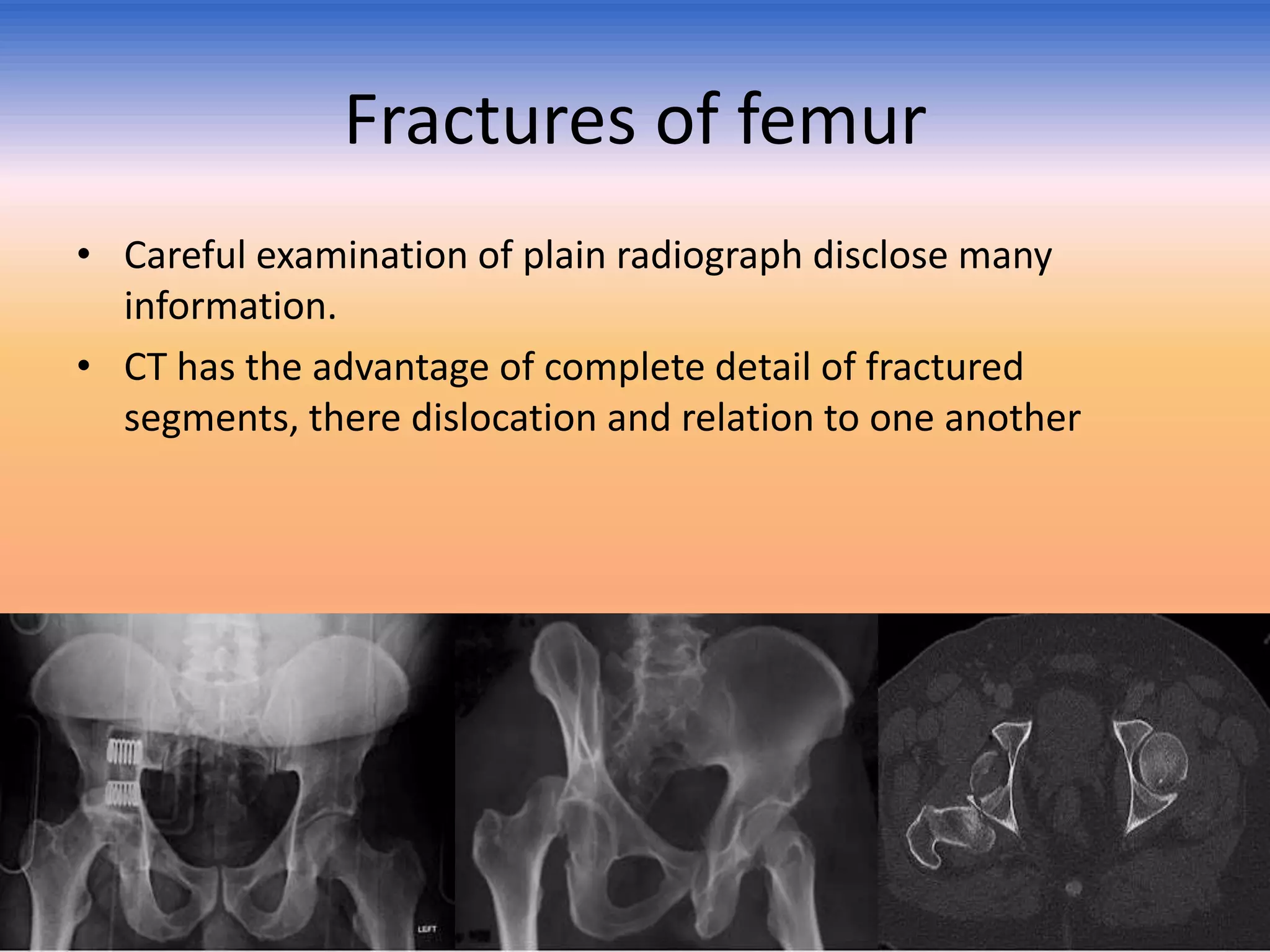 Fractures of femur
• Careful examination of plain radiograph disclose many
information.
• CT has the advantage of complete detail of fractured
segments, there dislocation and relation to one another

 