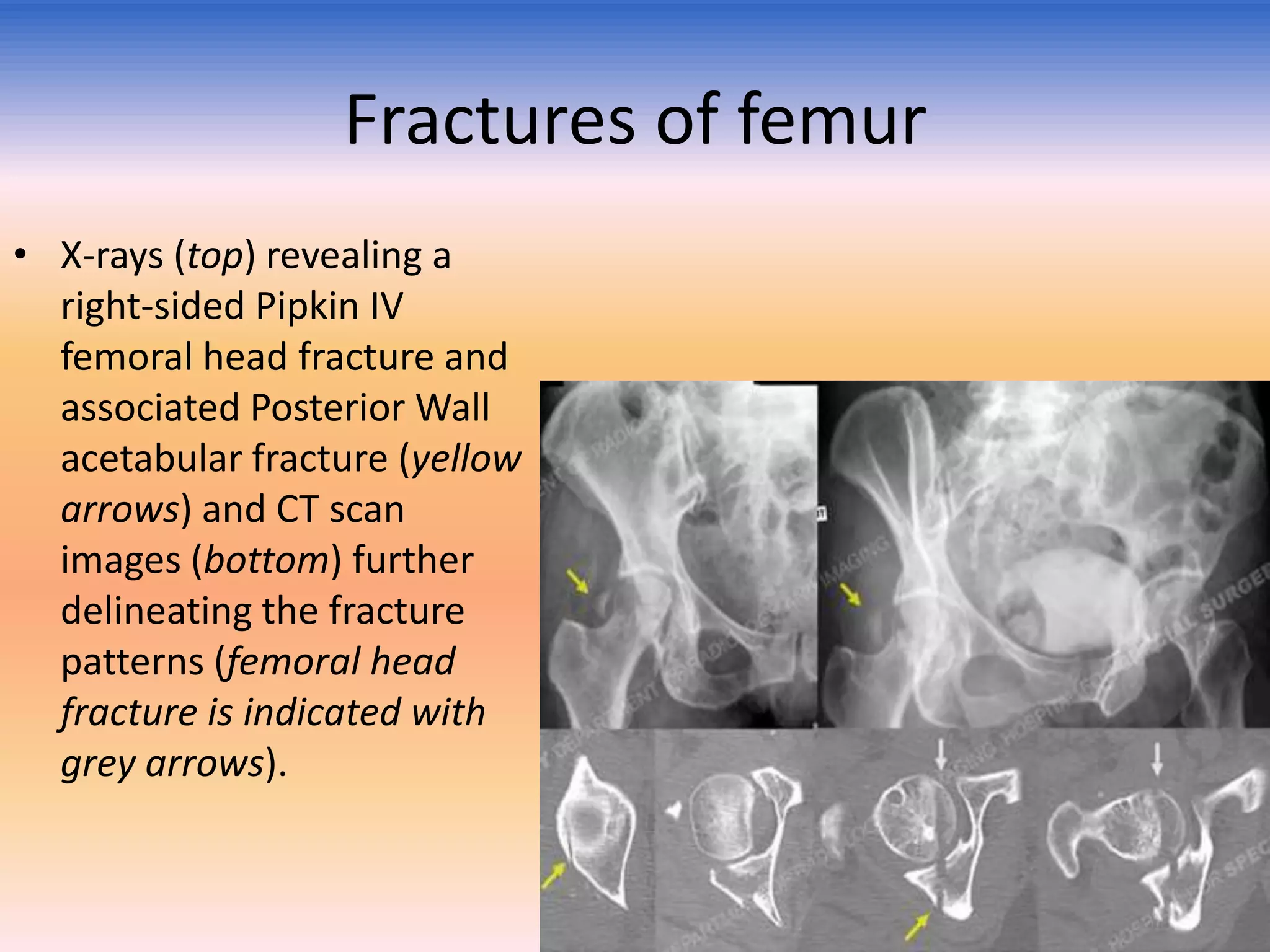 Fractures of femur
• X-rays (top) revealing a
right-sided Pipkin IV
femoral head fracture and
associated Posterior Wall
acetabular fracture (yellow
arrows) and CT scan
images (bottom) further
delineating the fracture
patterns (femoral head
fracture is indicated with
grey arrows).

 