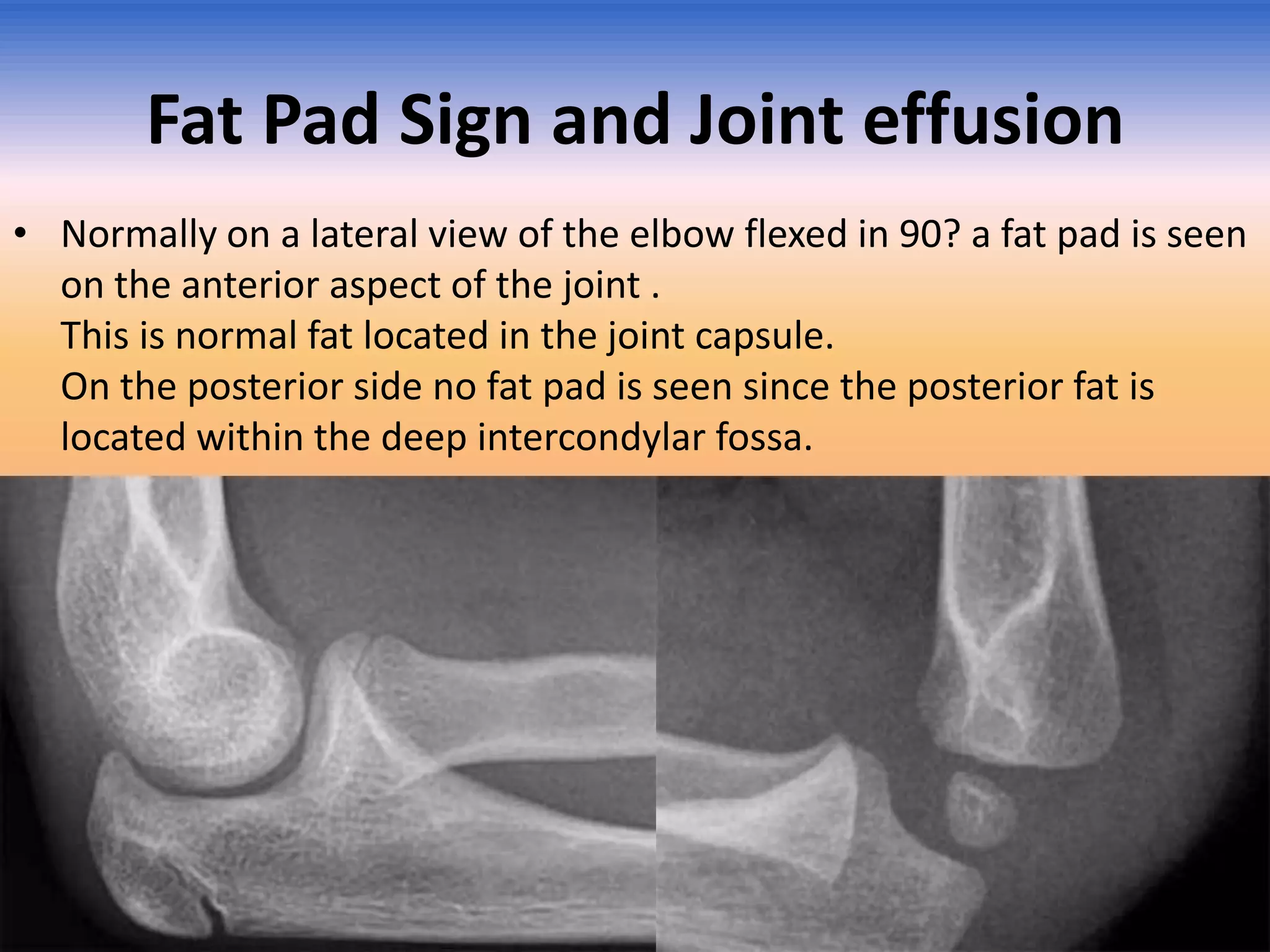 Fat Pad Sign and Joint effusion
• Normally on a lateral view of the elbow flexed in 90? a fat pad is seen
on the anterior aspect of the joint .
This is normal fat located in the joint capsule.
On the posterior side no fat pad is seen since the posterior fat is
located within the deep intercondylar fossa.

 