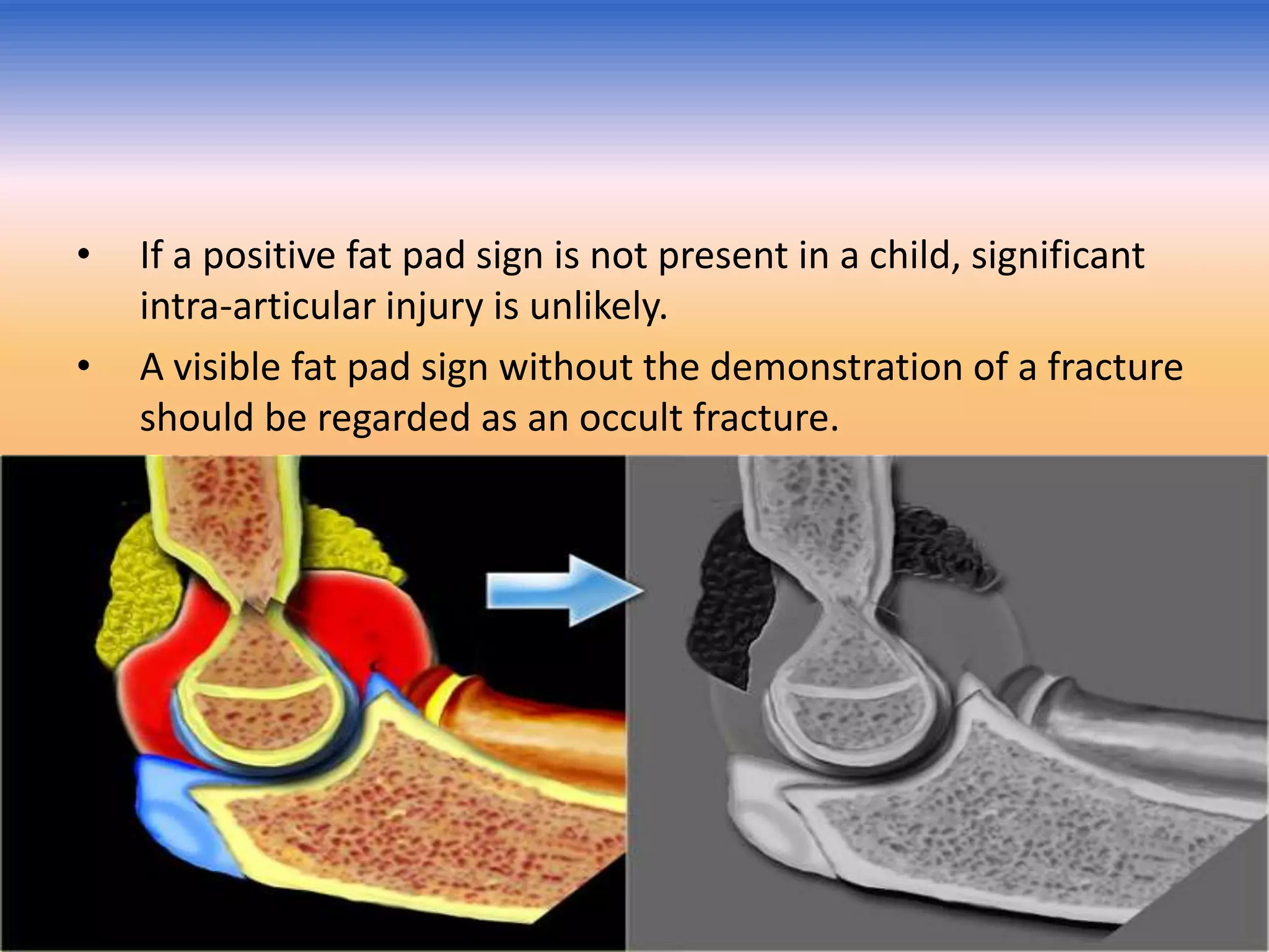 •
•

If a positive fat pad sign is not present in a child, significant
intra-articular injury is unlikely.
A visible fat pad sign without the demonstration of a fracture
should be regarded as an occult fracture.

 