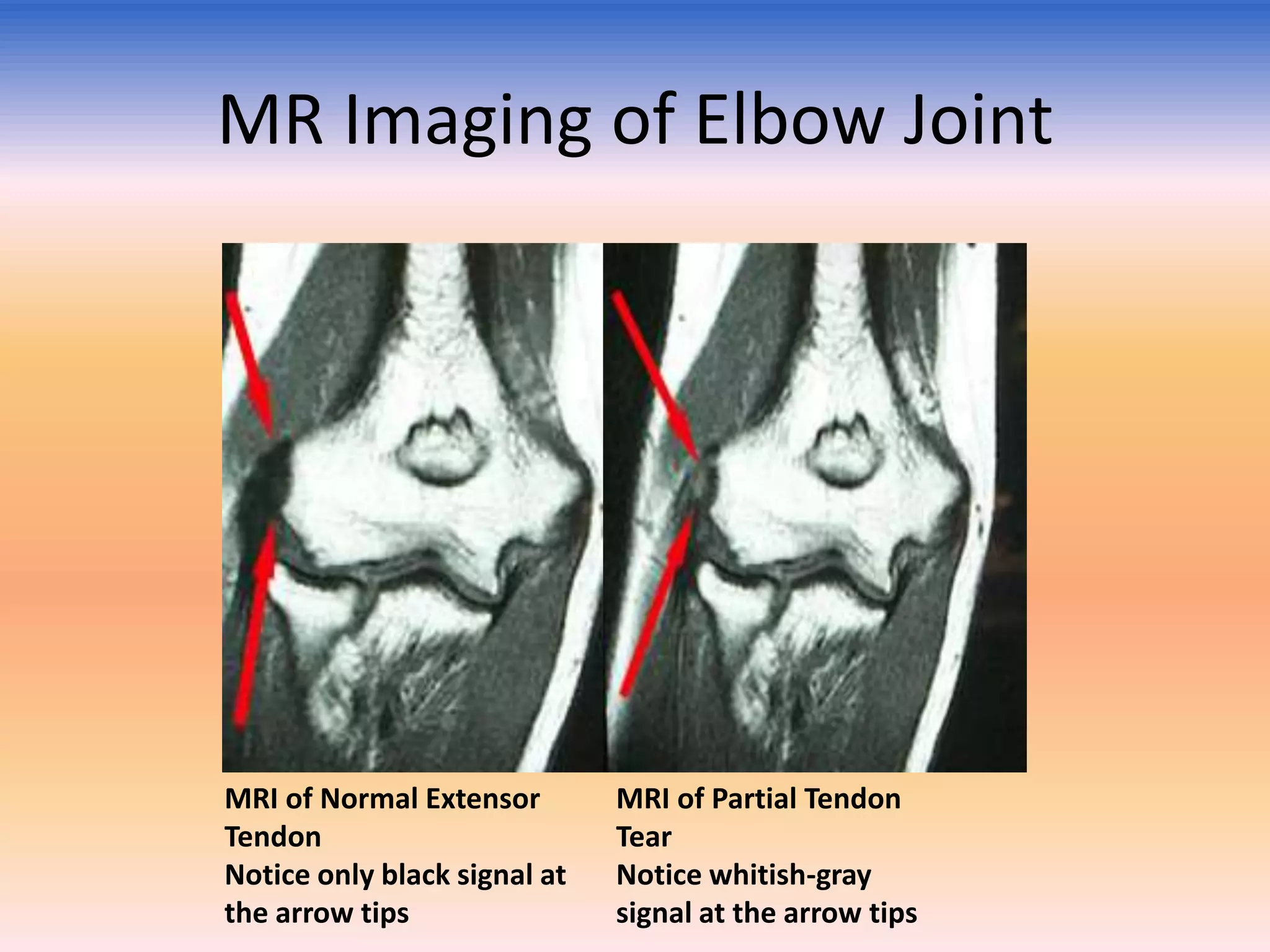 MR Imaging of Elbow Joint

MRI of Normal Extensor
Tendon
Notice only black signal at
the arrow tips

MRI of Partial Tendon
Tear
Notice whitish-gray
signal at the arrow tips

 