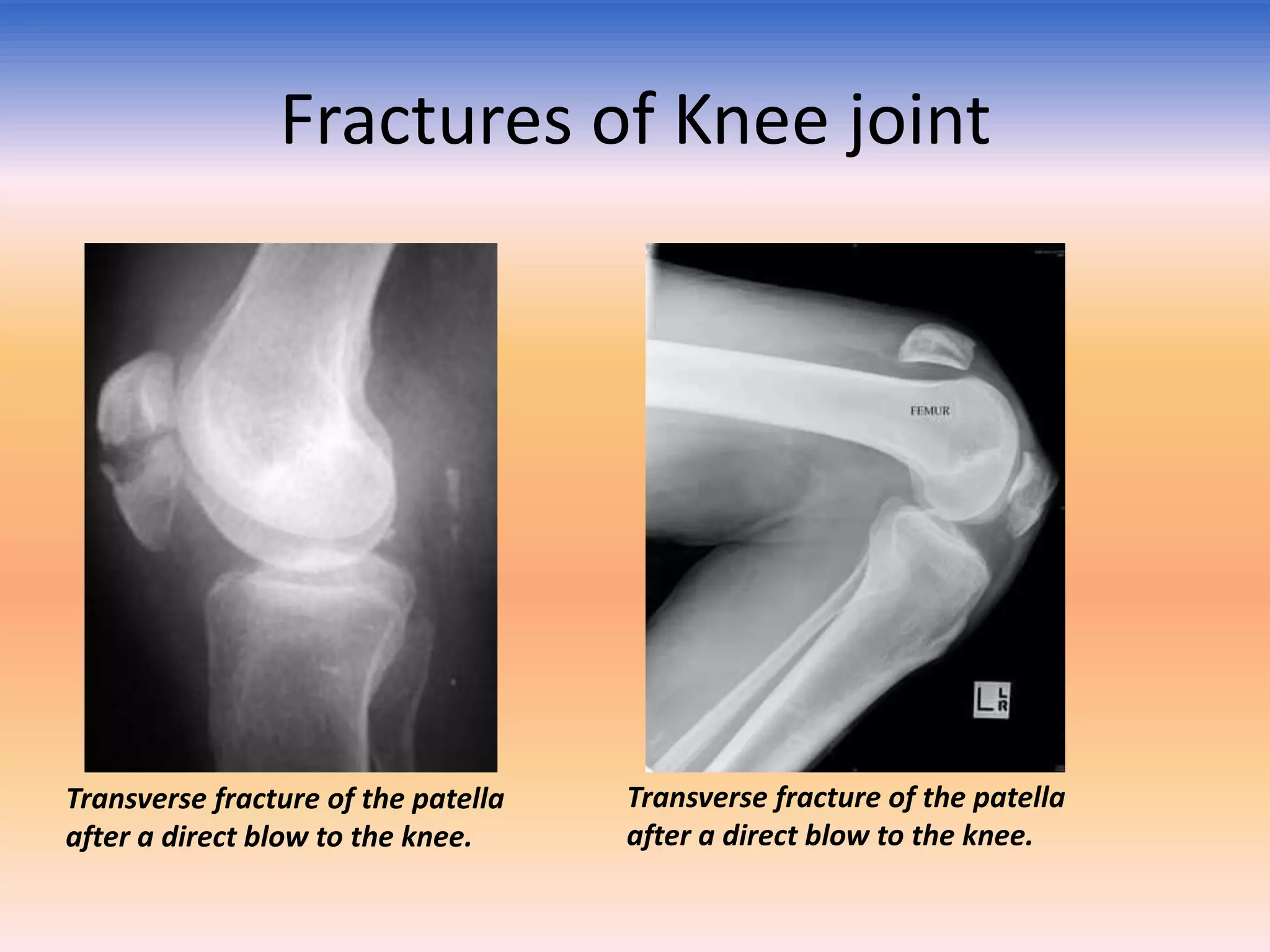 Fractures of Knee joint

Transverse fracture of the patella
after a direct blow to the knee.

Transverse fracture of the patella
after a direct blow to the knee.

 