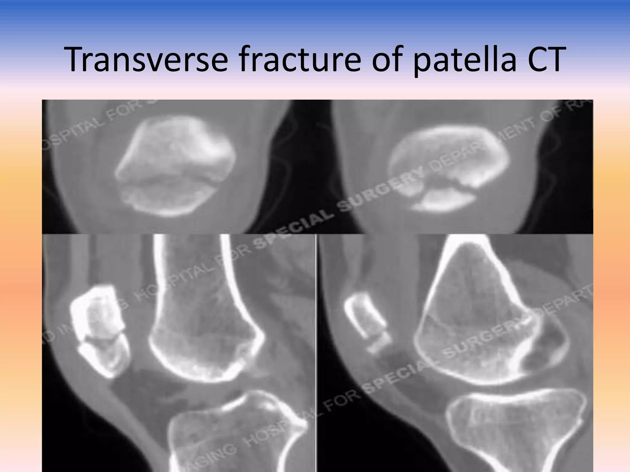 Transverse fracture of patella CT

 