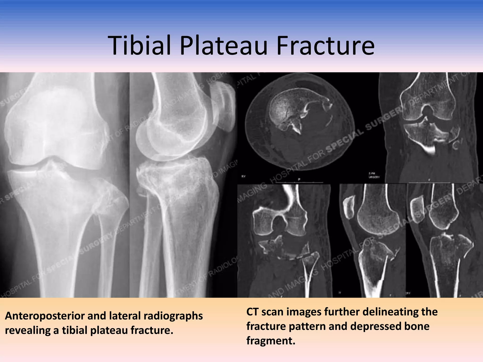 Tibial Plateau Fracture

Anteroposterior and lateral radiographs
revealing a tibial plateau fracture.

CT scan images further delineating the
fracture pattern and depressed bone
fragment.

 
