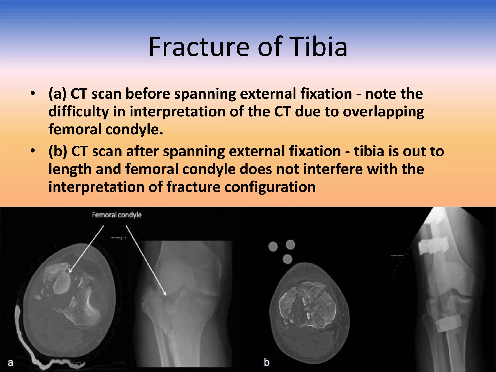 Fracture of Tibia
• (a) CT scan before spanning external fixation - note the
difficulty in interpretation of the CT due to overlapping
femoral condyle.
• (b) CT scan after spanning external fixation - tibia is out to
length and femoral condyle does not interfere with the
interpretation of fracture configuration

 