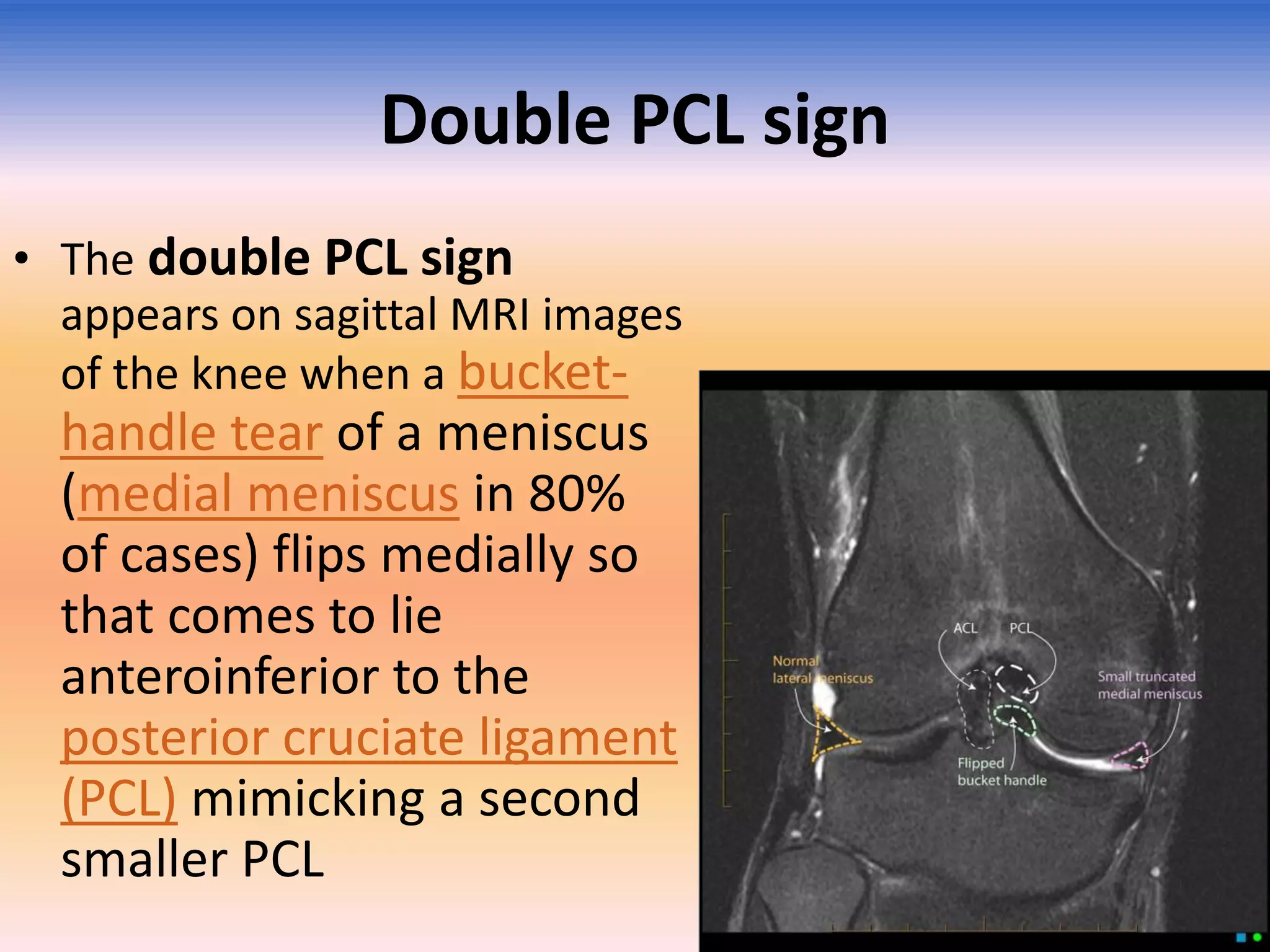 Double PCL sign
• The double PCL sign
appears on sagittal MRI images
of the knee when a bucket-

handle tear of a meniscus
(medial meniscus in 80%
of cases) flips medially so
that comes to lie
anteroinferior to the
posterior cruciate ligament
(PCL) mimicking a second
smaller PCL

 