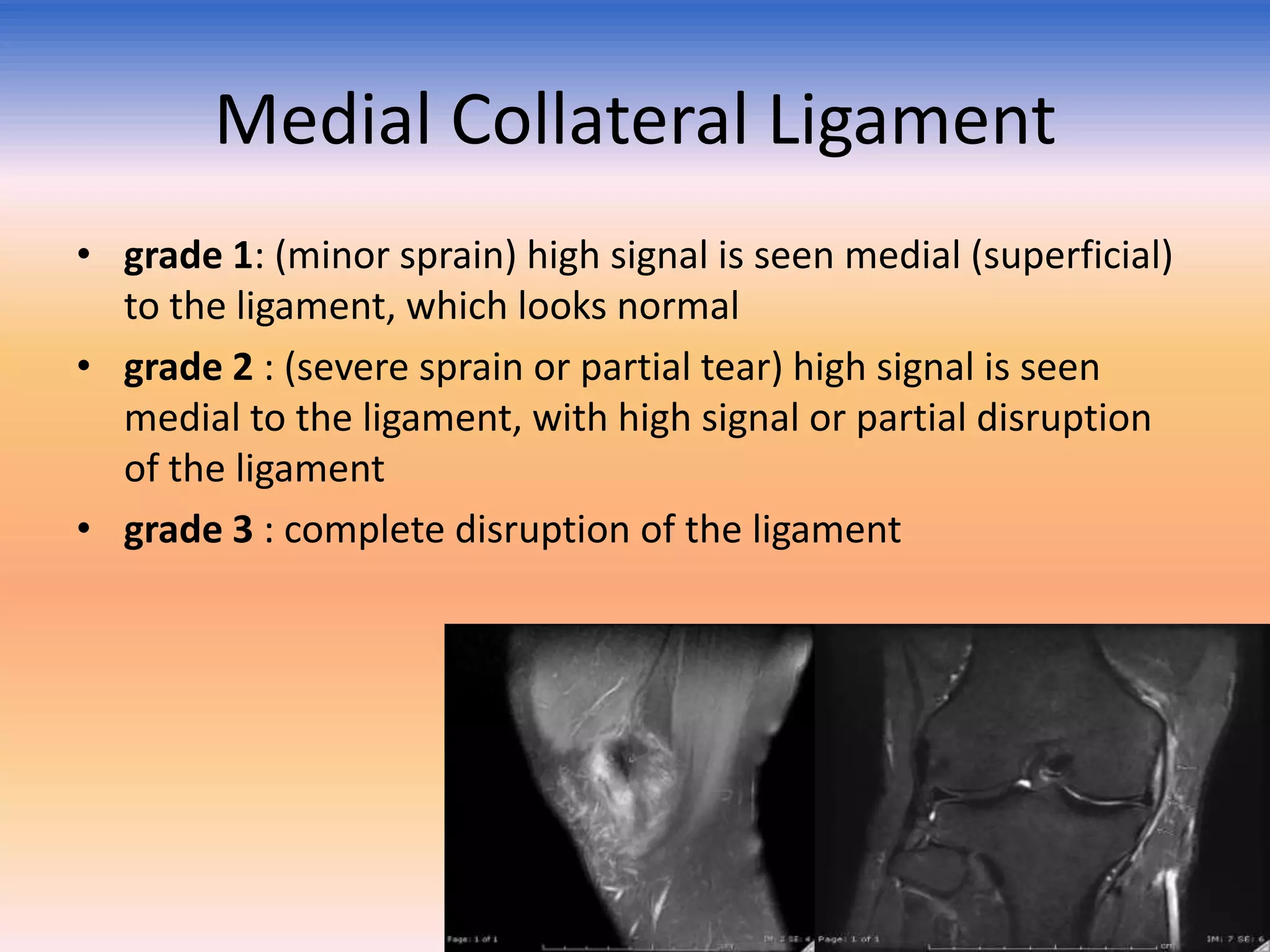 Medial Collateral Ligament
• grade 1: (minor sprain) high signal is seen medial (superficial)
to the ligament, which looks normal
• grade 2 : (severe sprain or partial tear) high signal is seen
medial to the ligament, with high signal or partial disruption
of the ligament
• grade 3 : complete disruption of the ligament

 