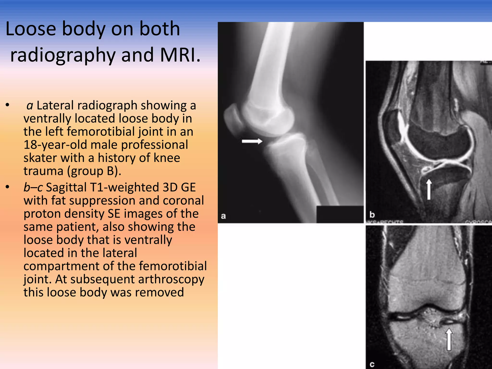 Loose body on both
radiography and MRI.
•

a Lateral radiograph showing a
ventrally located loose body in
the left femorotibial joint in an
18-year-old male professional
skater with a history of knee
trauma (group B).
• b–c Sagittal T1-weighted 3D GE
with fat suppression and coronal
proton density SE images of the
same patient, also showing the
loose body that is ventrally
located in the lateral
compartment of the femorotibial
joint. At subsequent arthroscopy
this loose body was removed

 