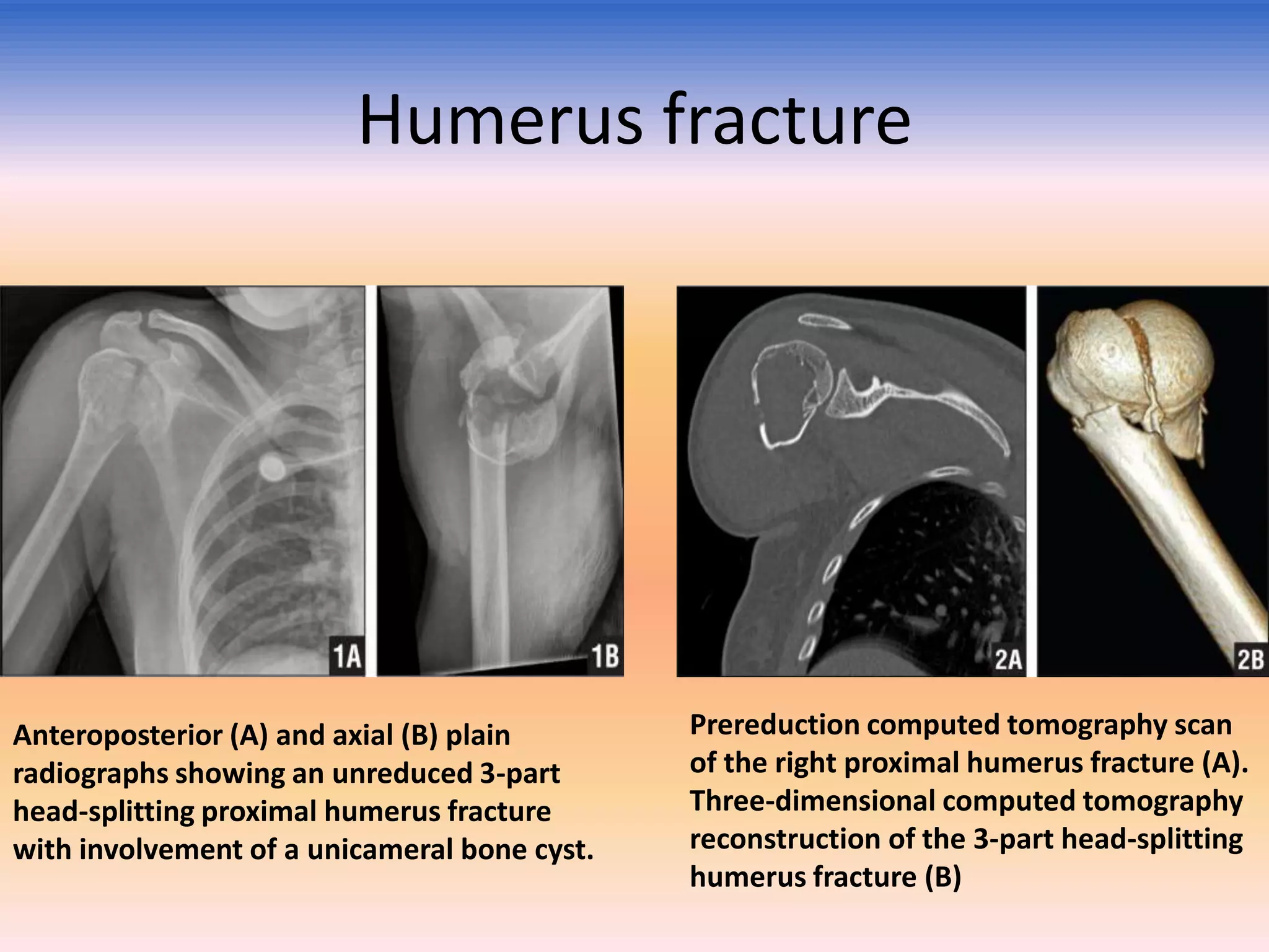 Humerus fracture

Anteroposterior (A) and axial (B) plain
radiographs showing an unreduced 3-part
head-splitting proximal humerus fracture
with involvement of a unicameral bone cyst.

Prereduction computed tomography scan
of the right proximal humerus fracture (A).
Three-dimensional computed tomography
reconstruction of the 3-part head-splitting
humerus fracture (B)

 