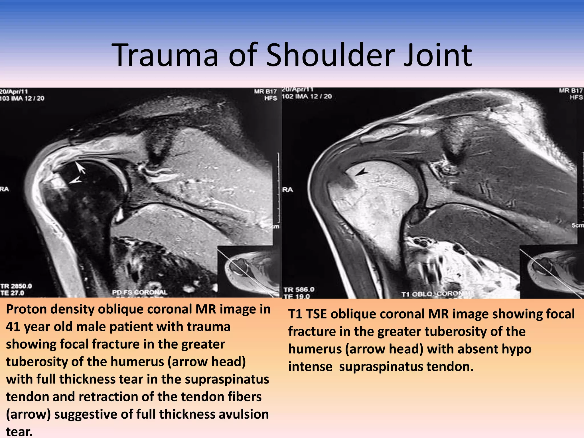 Trauma of Shoulder Joint

Proton density oblique coronal MR image in
41 year old male patient with trauma
showing focal fracture in the greater
tuberosity of the humerus (arrow head)
with full thickness tear in the supraspinatus
tendon and retraction of the tendon fibers
(arrow) suggestive of full thickness avulsion
tear.

T1 TSE oblique coronal MR image showing focal
fracture in the greater tuberosity of the
humerus (arrow head) with absent hypo
intense supraspinatus tendon.

 