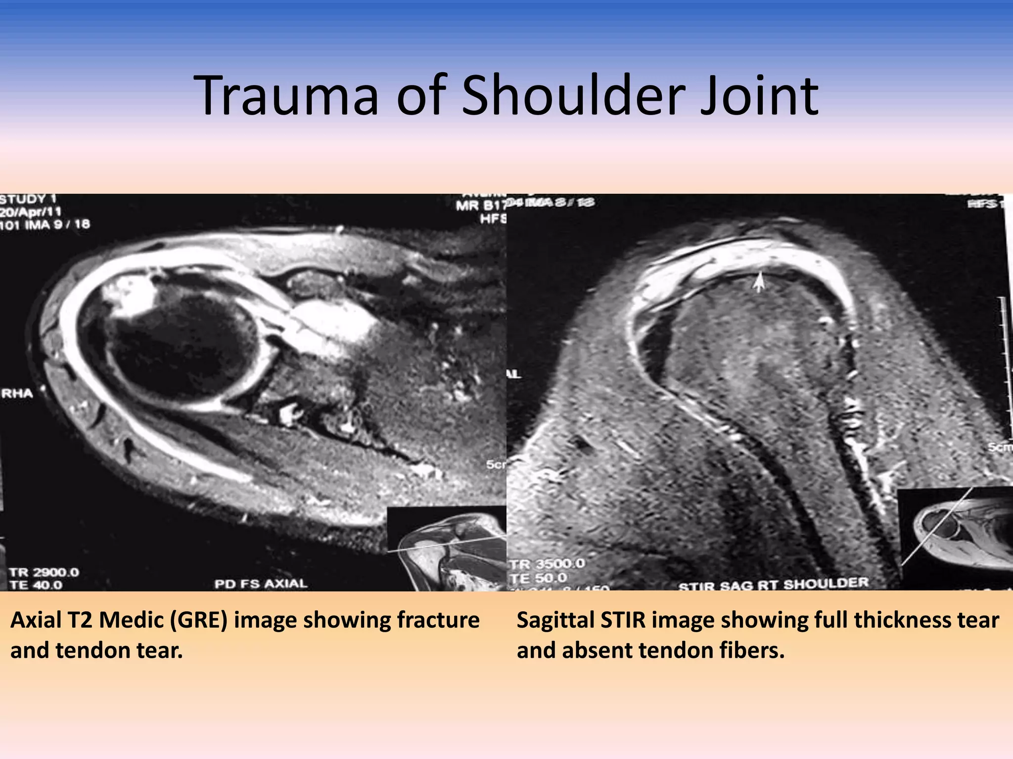 Trauma of Shoulder Joint

Axial T2 Medic (GRE) image showing fracture
and tendon tear.

Sagittal STIR image showing full thickness tear
and absent tendon fibers.

 