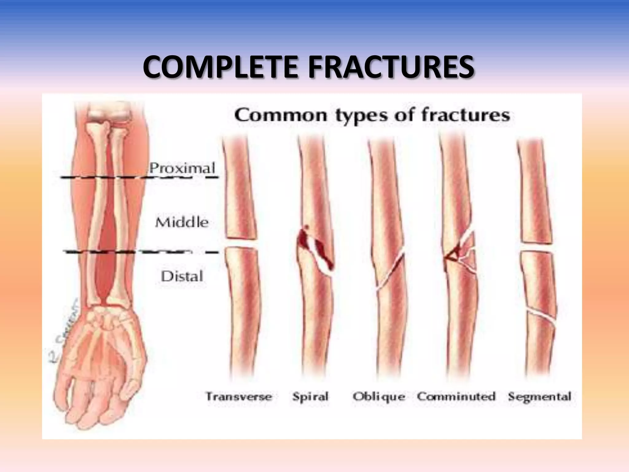 COMPLETE FRACTURES

 
