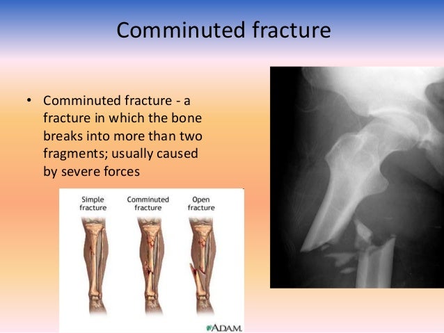 comminuted fracture causes