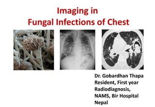 Imaging in
Fungal Infections of Chest
Dr. Gobardhan Thapa
Resident, First year
Radiodiagnosis,
NAMS, Bir Hospital
Nepal
 