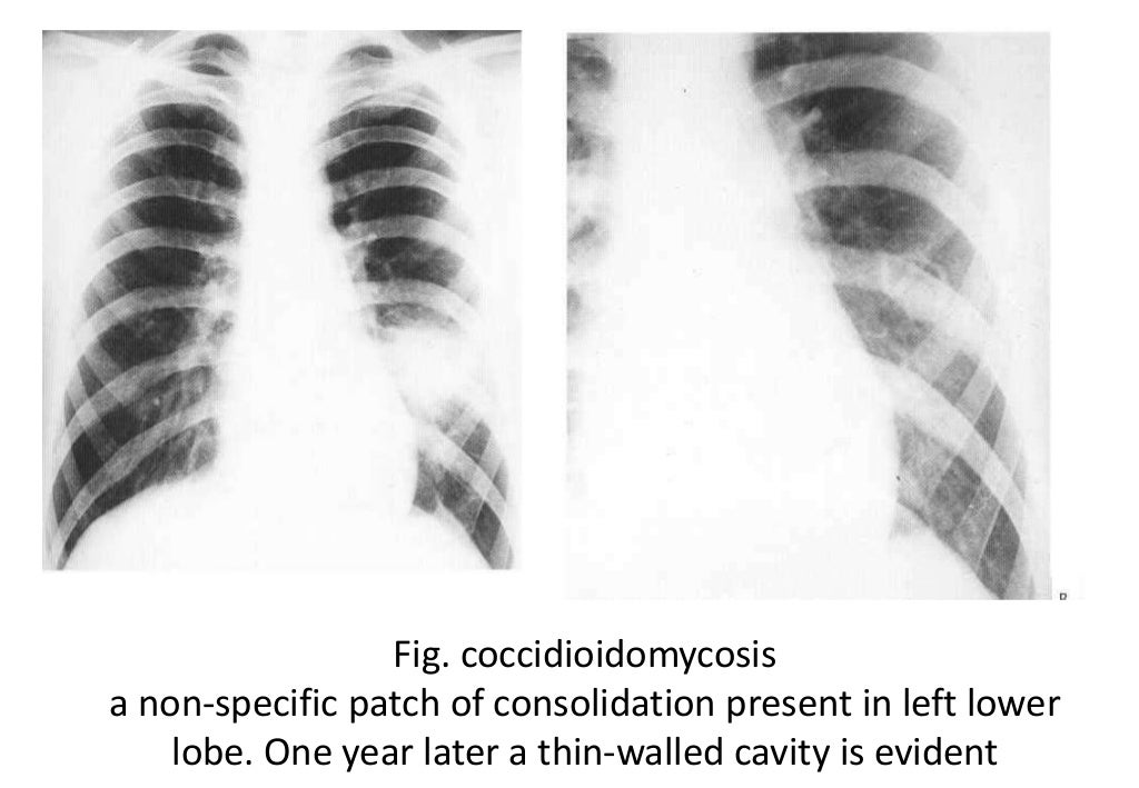 Imaging in fungal infection of chest