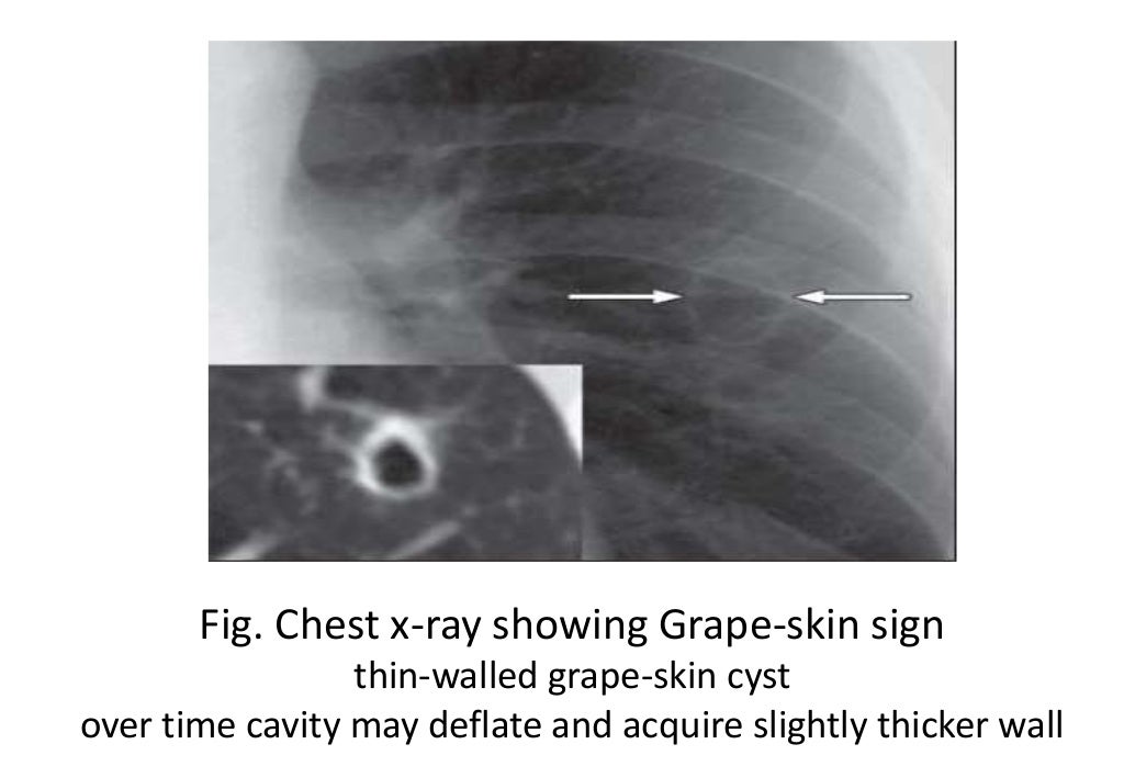 Imaging in fungal infection of chest