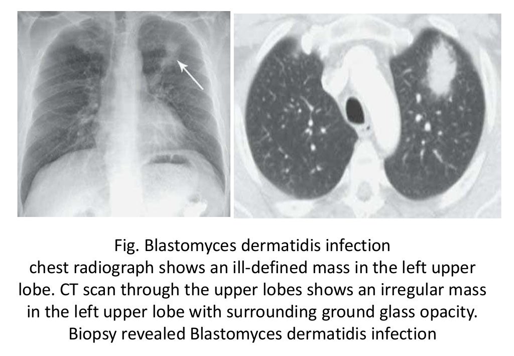 Imaging in fungal infection of chest