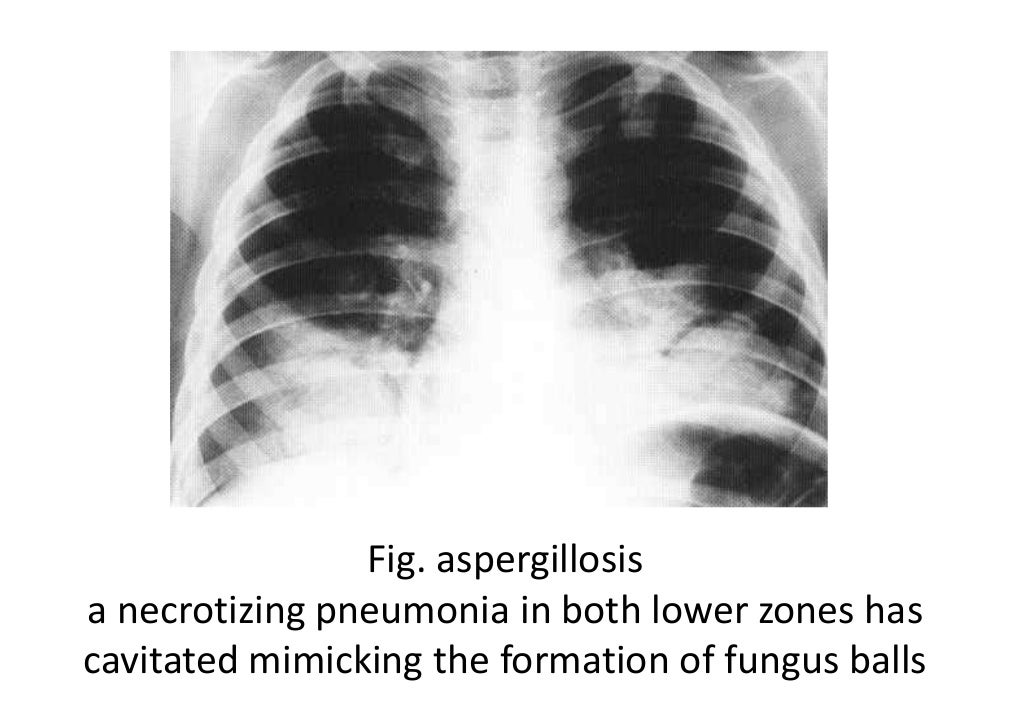Imaging in fungal infection of chest