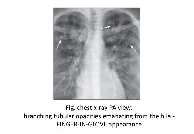 1 dilated finger fungal chest in Imaging of infection