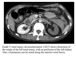 Devascularization Ct Imaging in genitourinary trauma | PPT