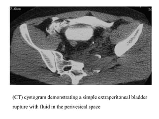 Imaging in genitourinary trauma | PPT