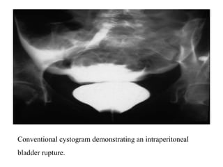 Imaging in genitourinary trauma | PPT