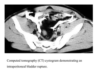 Imaging in genitourinary trauma | PPT