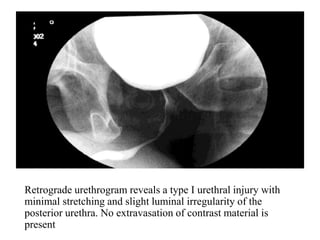 Retrograde Urethrogram Rupture Imaging in genitourinary trauma | PPT